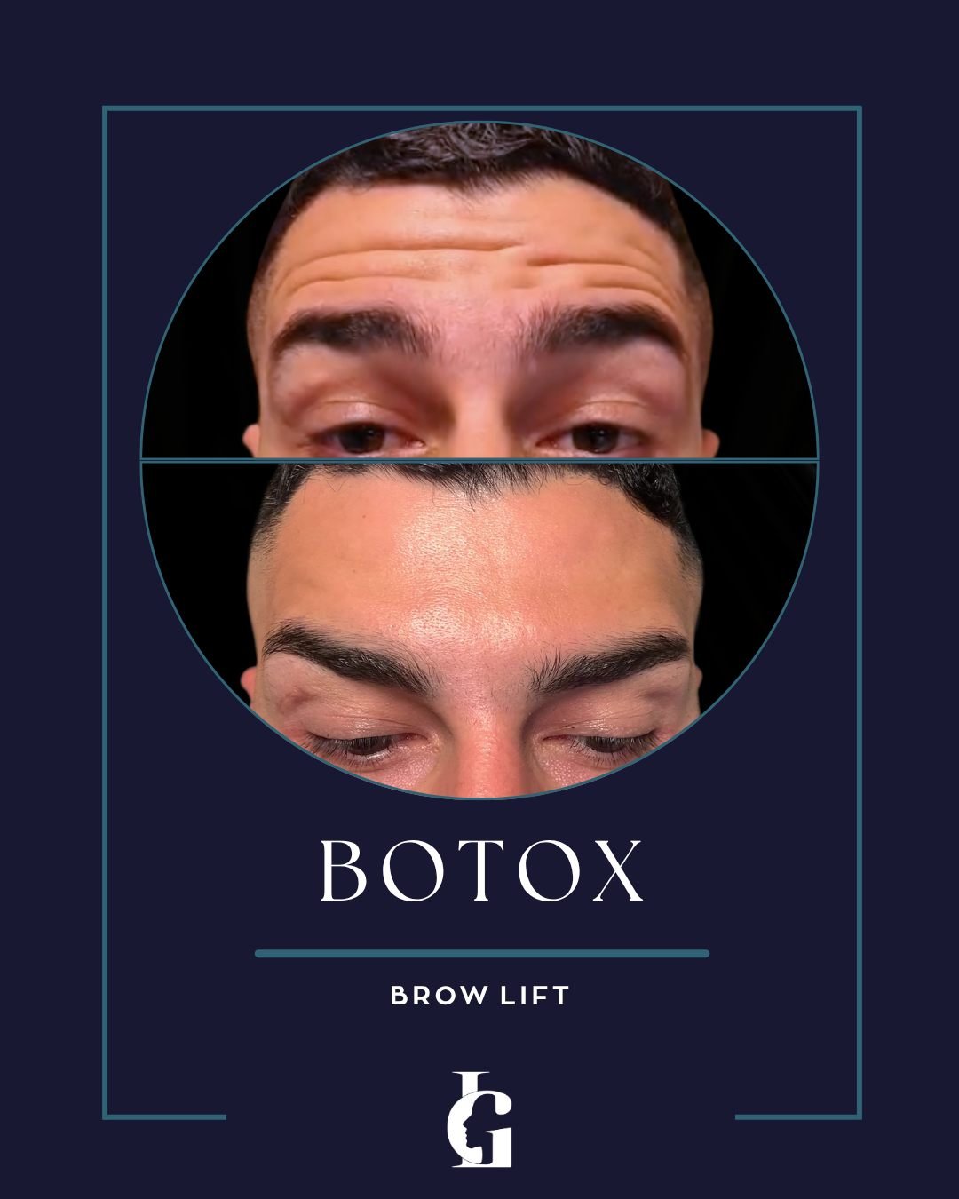 Niente eccessi, niente "effetto blocco": solo una pelle visibilmente pi&ugrave; levigata, un effetto lifting del sopracciglio (Brow Lift) e uno sguardo pi&ugrave; aperto e riposato mantenendo parte della mimica naturale.

🏛️ Via Citarella 