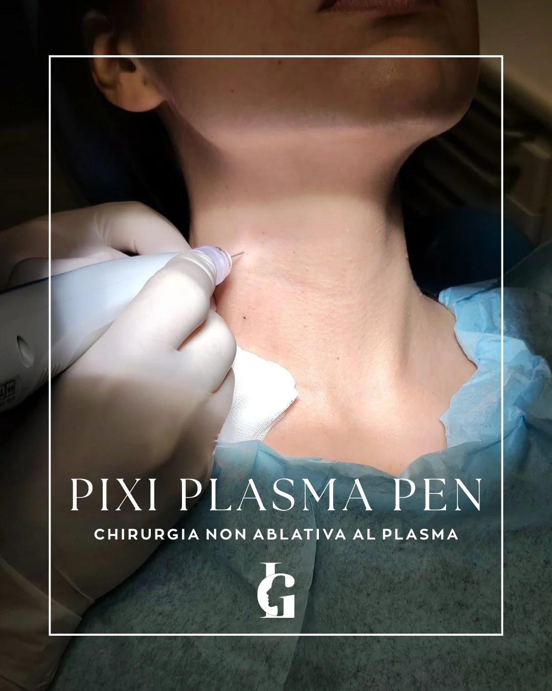 Addio inestetismi del collo con la tecnologia al Plasma. ⚡️

Molti pazienti convivono per anni con piccoli fibromi o neoformazioni, rimandando il trattamento per timore del bisturi o delle cicatrici. Con la tecnologia Pixi, interveniamo in maniera es