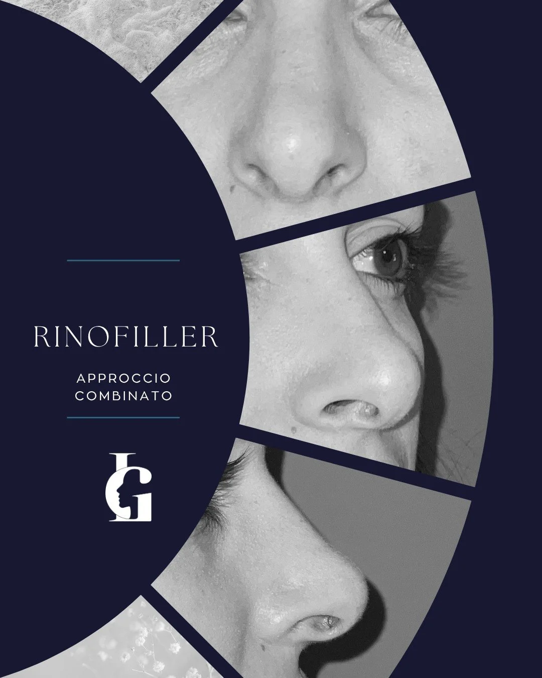 L&rsquo;armonia del profilo non &egrave; una questione di volume, ma di equilibri. ✨
In questo caso di Rinofiller abbiamo adottato un approccio combinato: l'uso sinergico di filler dermico e tossina botulinica.
1️⃣ Filler: per definire il dorso e sol