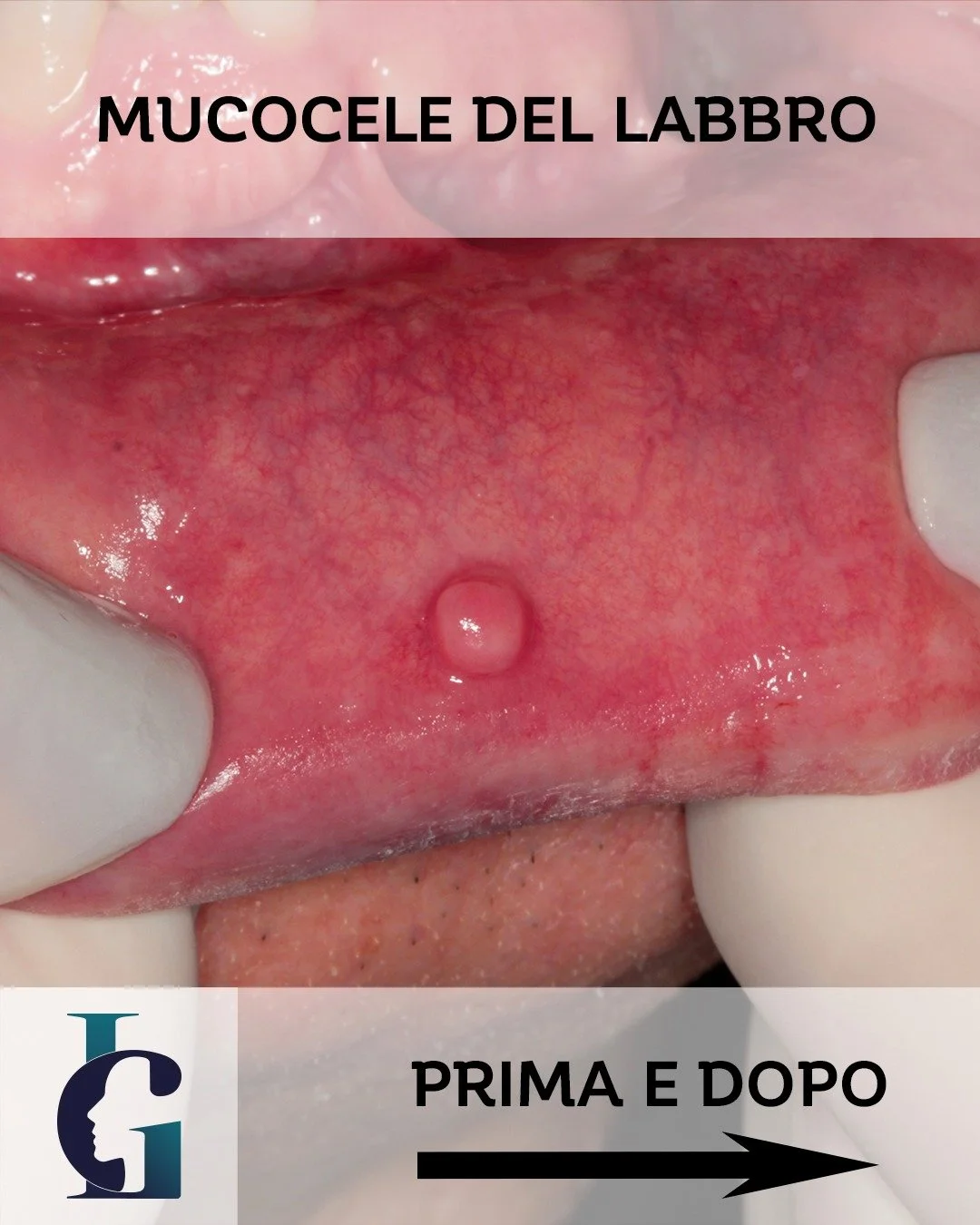 Mucocele del Labbro Inferiore: Cosa Devi Sapere 🧐
Ti &egrave; mai capitato di mordicchiarti il labbro e veder comparire un rigonfiamento? Oggi parliamo proprio di questo: il Mucocele del labbro inferiore. 🩹

Cos'&egrave; ?
Il Mucocele &egrave; una 
