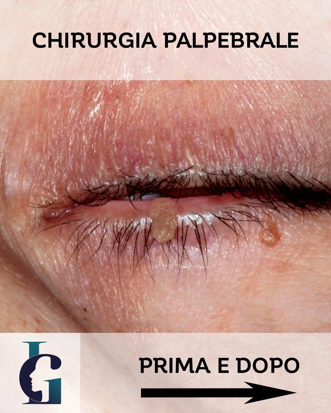 Un esempio di chirurgia che richiede massima attenzione al dettaglio. 📐
Oggi condivido la gestione di un fibroma situato in una posizione estremamente particolare: tra la rima cigliare inferiore e la congiuntiva palpebrale. 

L'obiettivo principale 