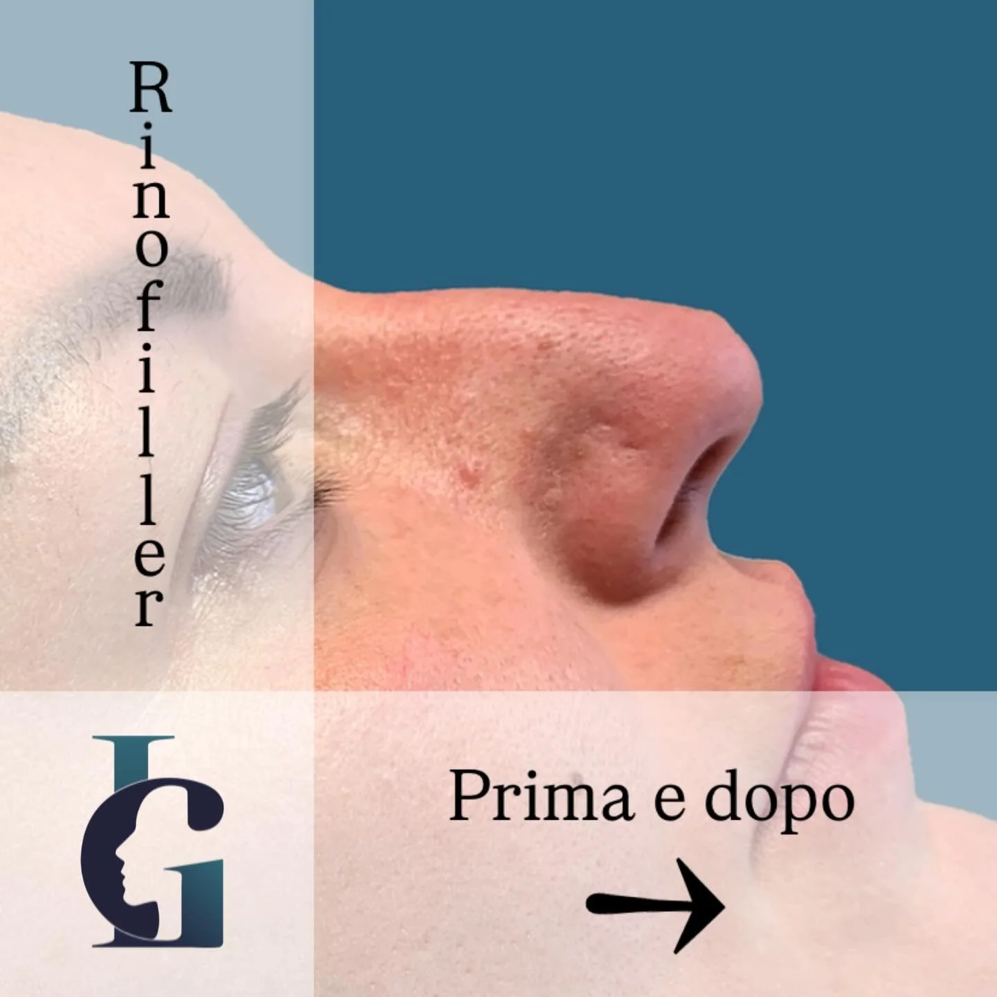 Vuoi un profilo pi&ugrave; armonioso ma senza bisturi? Il Rinofiller &egrave; la soluzione non chirurgica.💉
Oggi vi mostro un risultato di un trattamento che punta all&rsquo;eleganza discreta e naturalezza. Attraverso l&rsquo;uso mirato del filler, 