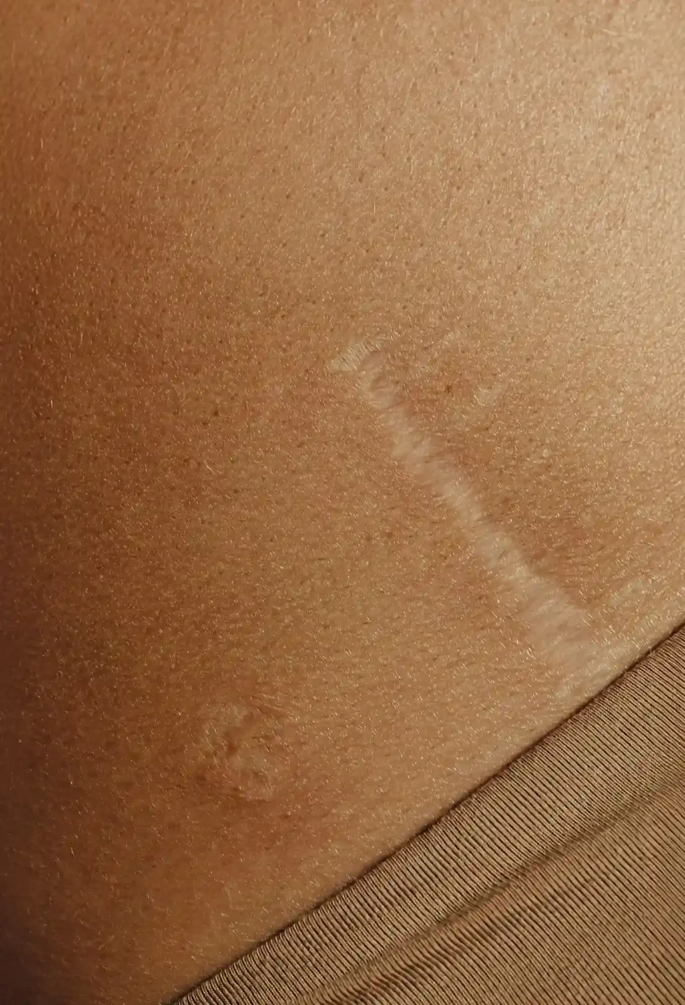 Image of skin with scar for postoperative skin treatments.