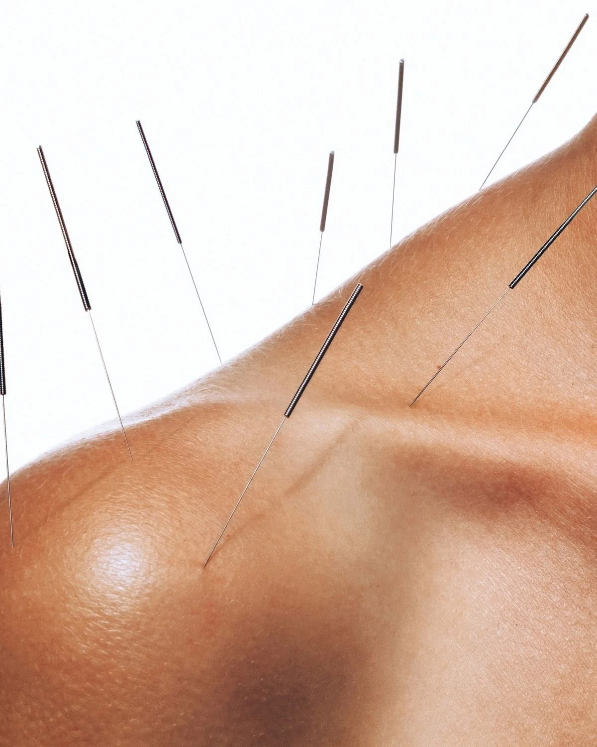 Close-up of a person's shoulder with acupuncture needles inserted.