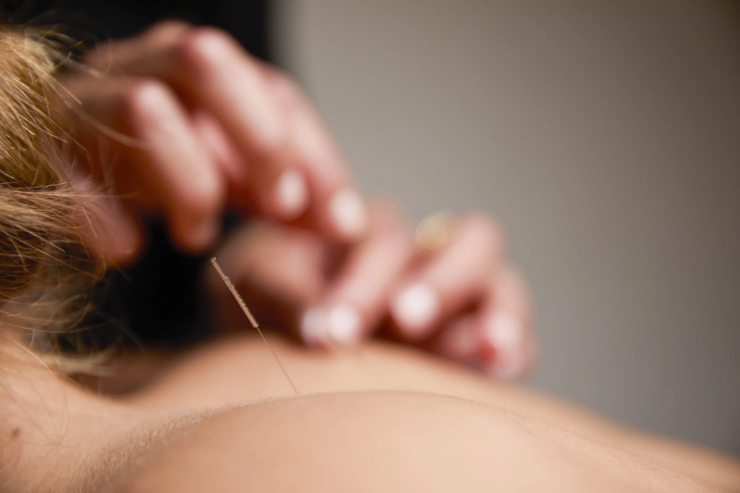 Close-up of a person receiving acupuncture treatment, with a thin acupuncture needle inserted into their skin.