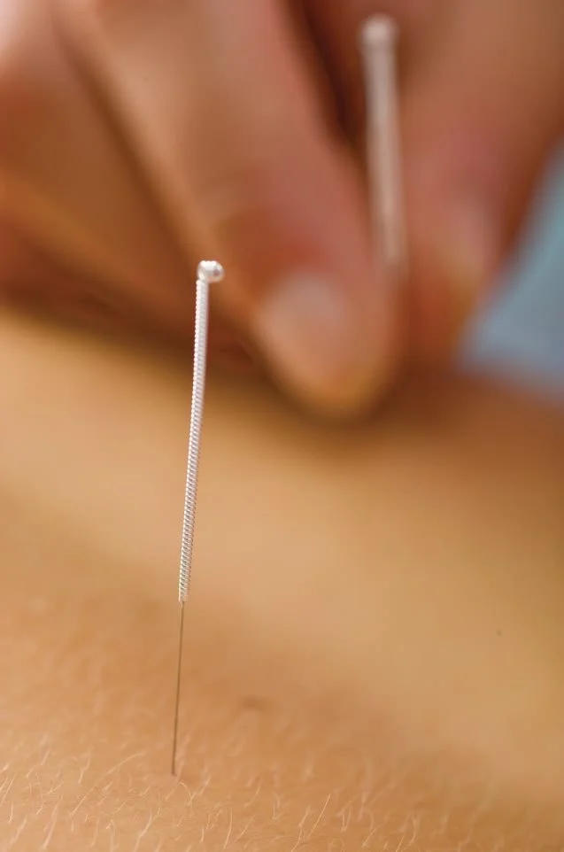 Close-up of an acupuncture needle inserted into skin, with a practitioner's hand holding a second needle in the background.