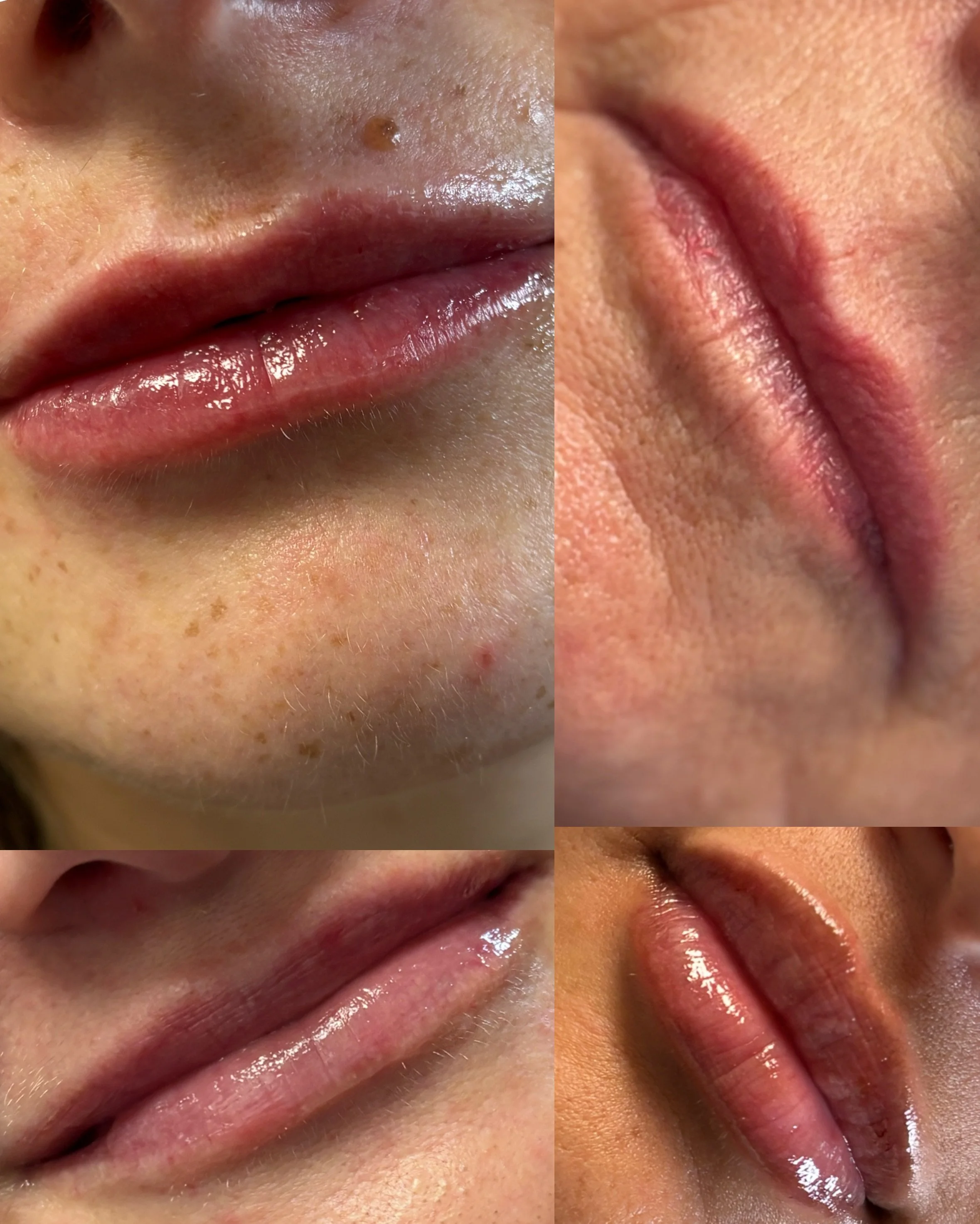 Lip Filler That Enhances — Not Changes — You 💋