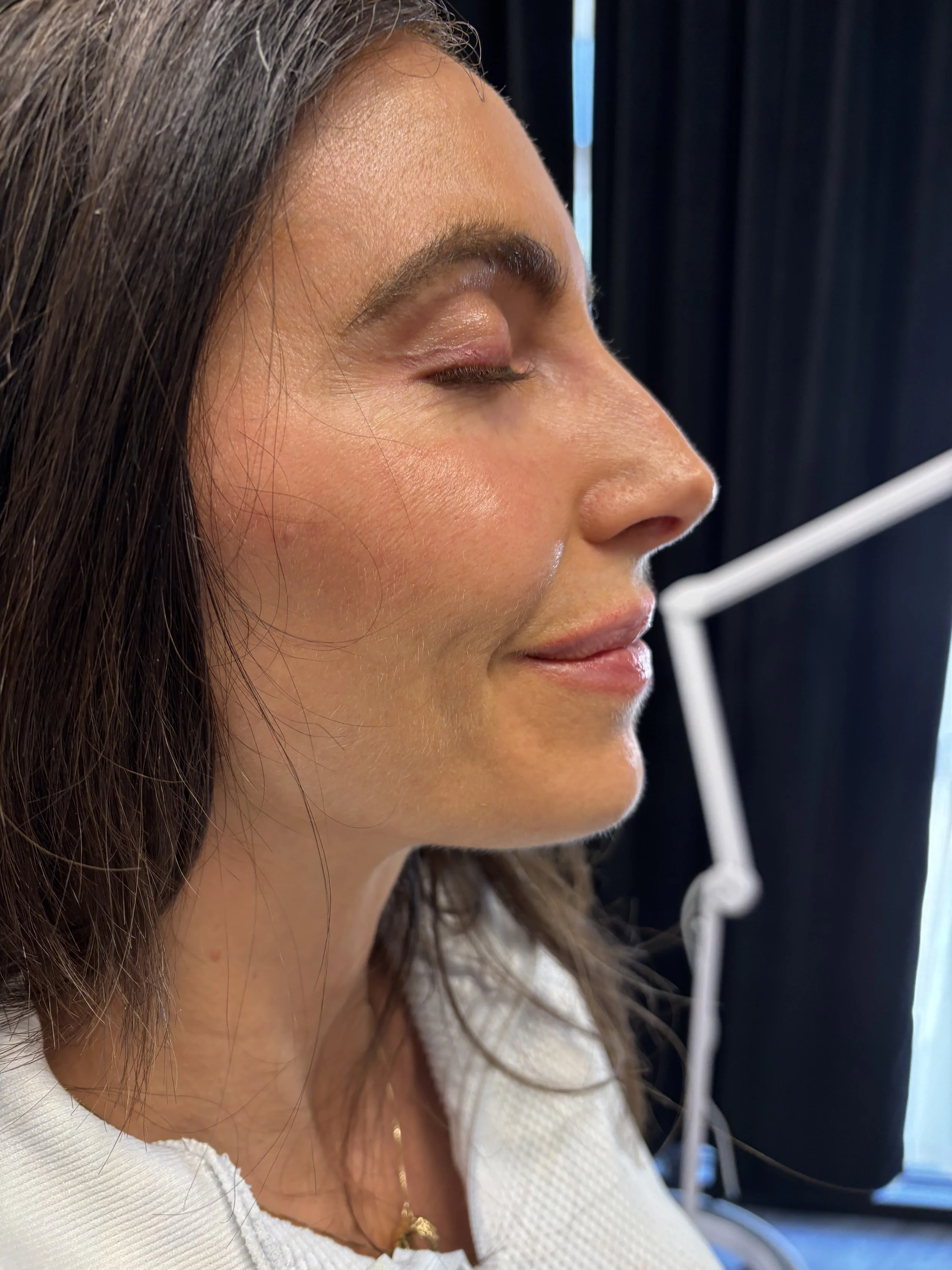 Youthful Glow Dermal Filler Service