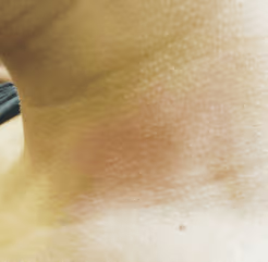 Close-up of skin on the neck showing redness and irritation.