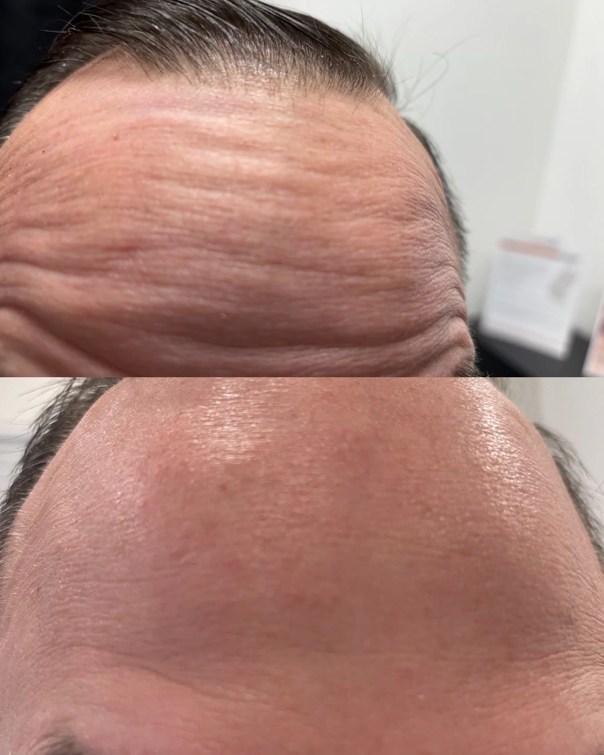 How Long Does Botox Last? A Complete Guide for First-Time Patients
