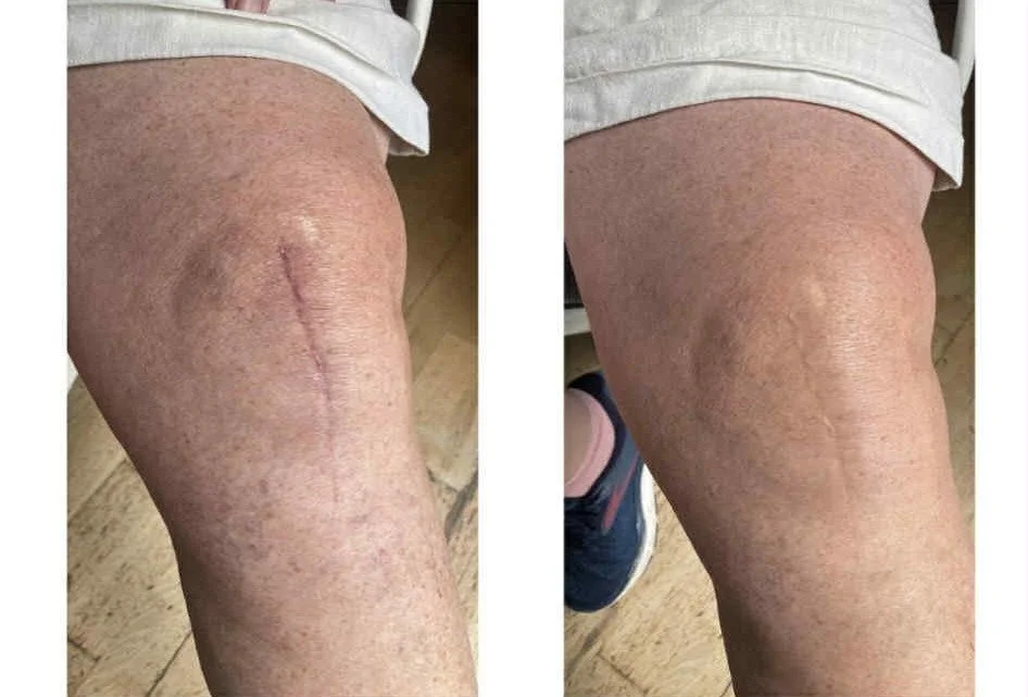 Knee scar.jpg