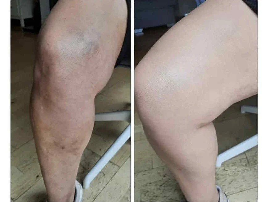 Leg scar.jpg