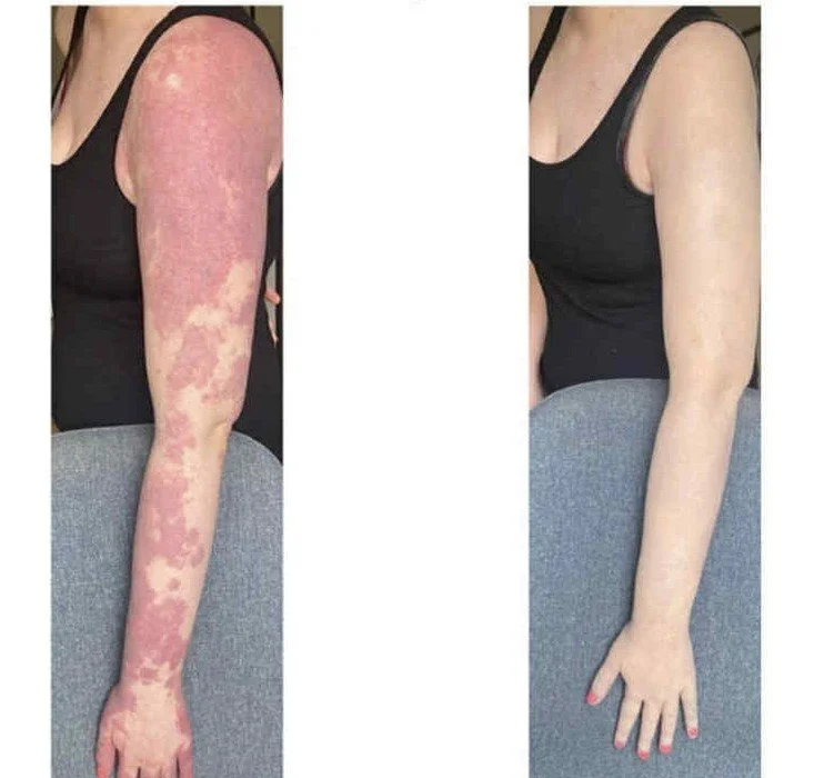 PW Stain arm.jpg