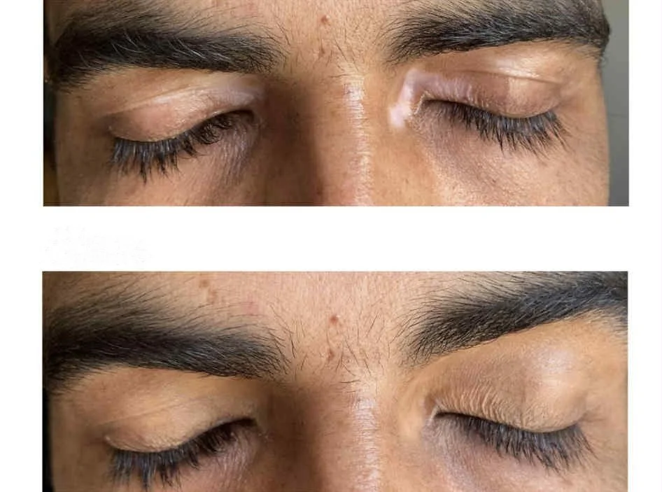 Vitiligo eyes2.jpg