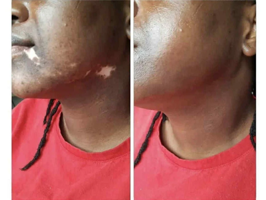 Vitiligo face.jpg
