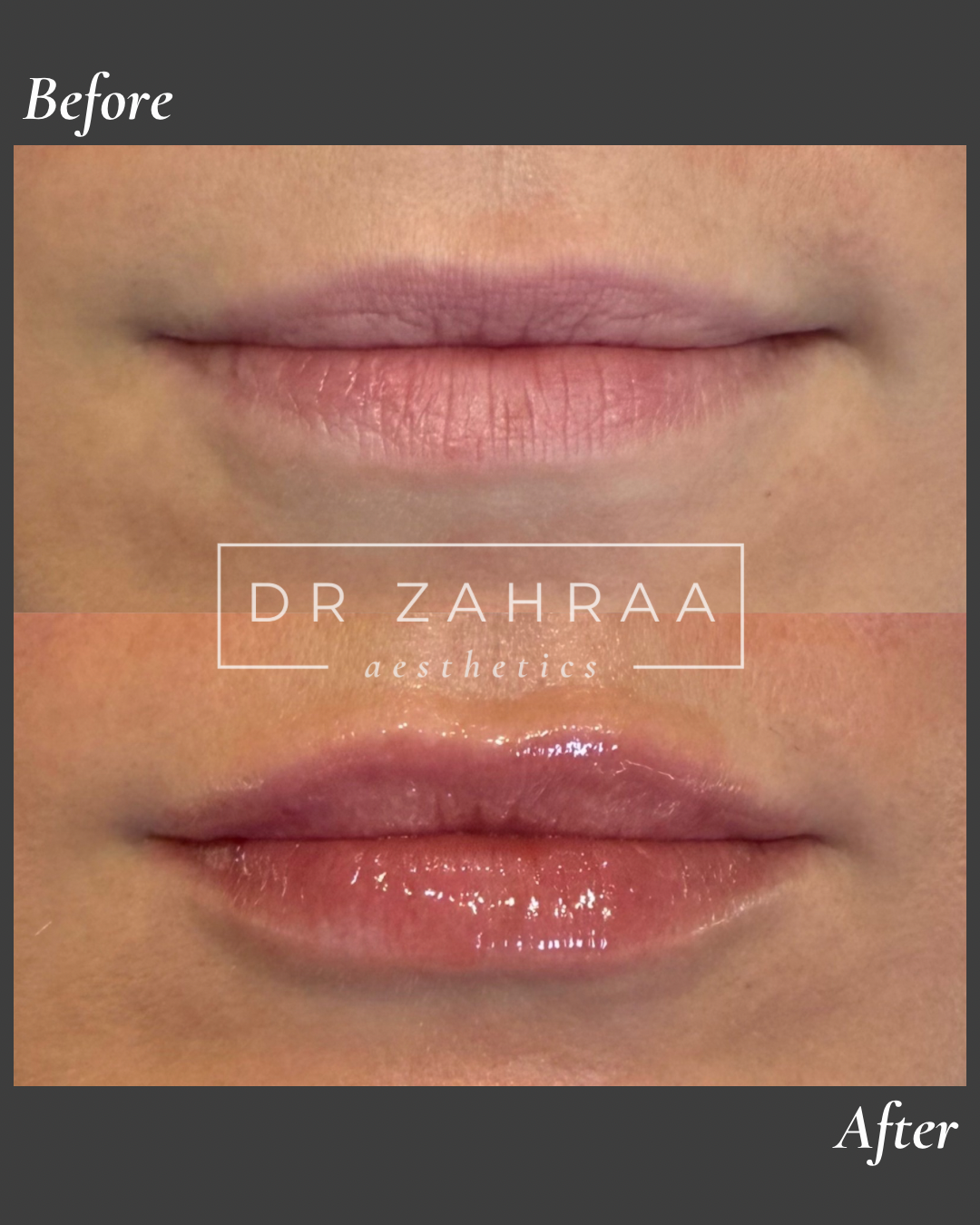 Lip Filler before and after in Wandsworth clinic