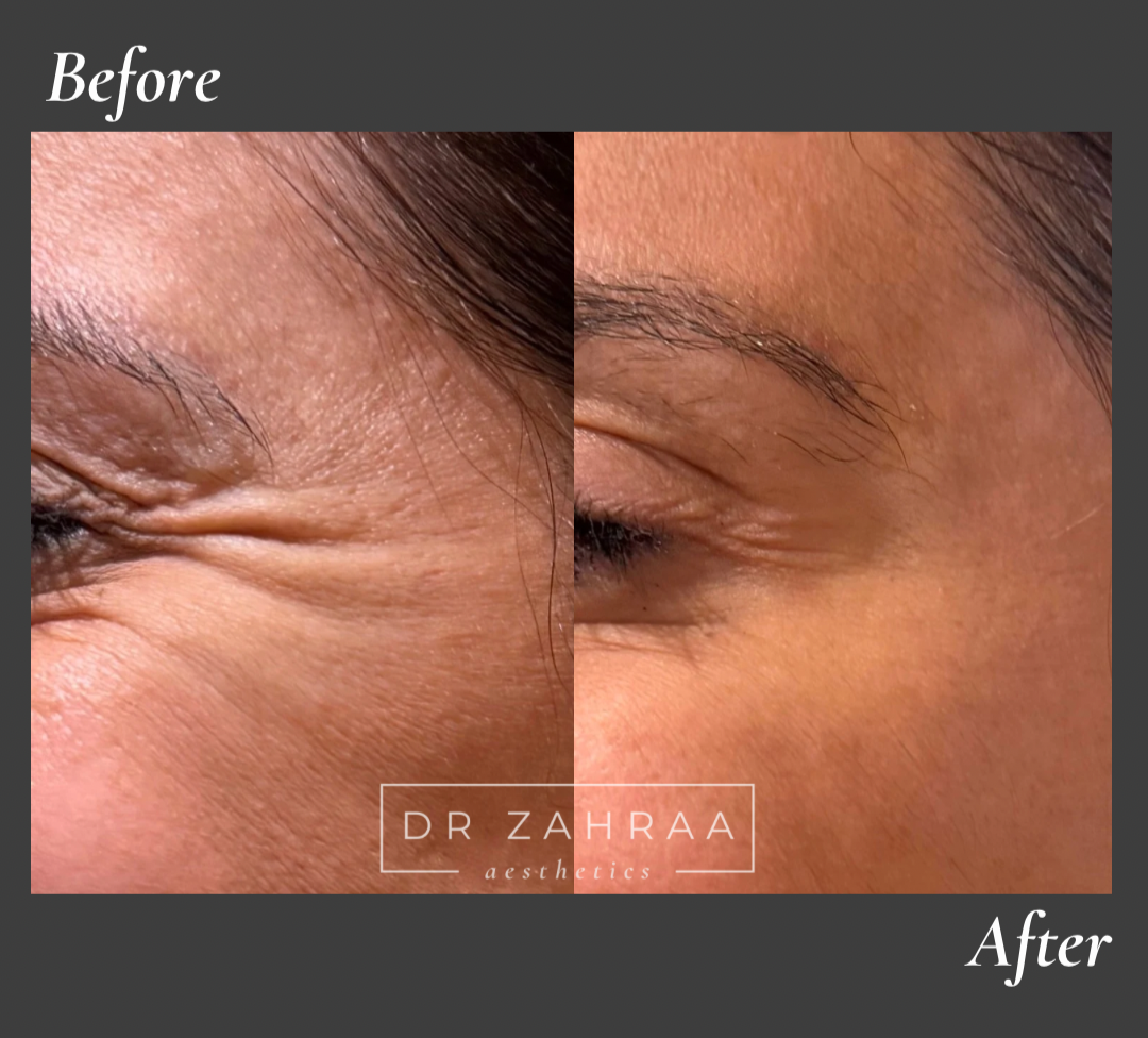 Botox before and after Wandsworth clinic
