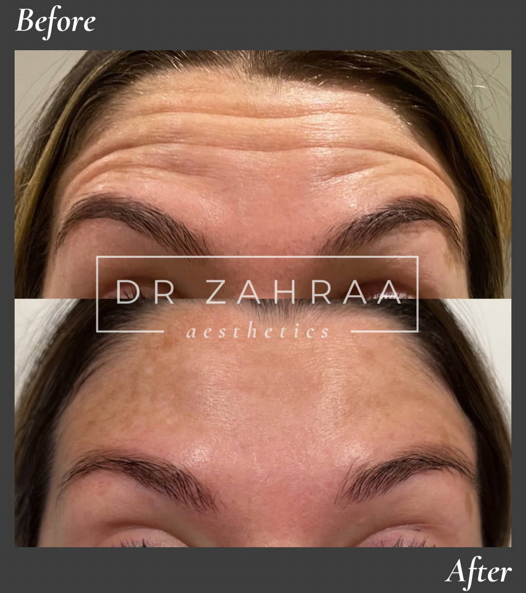 Forehead Botox before and after Wandsworth clinic