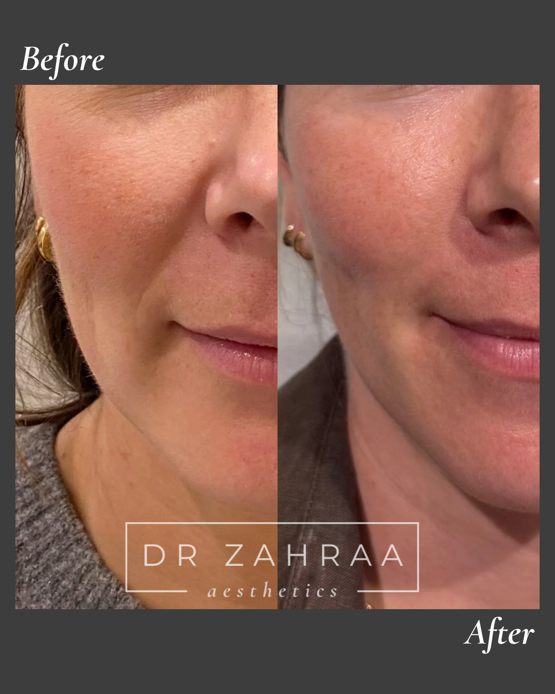 Profhilo face treatment in Wandsworth