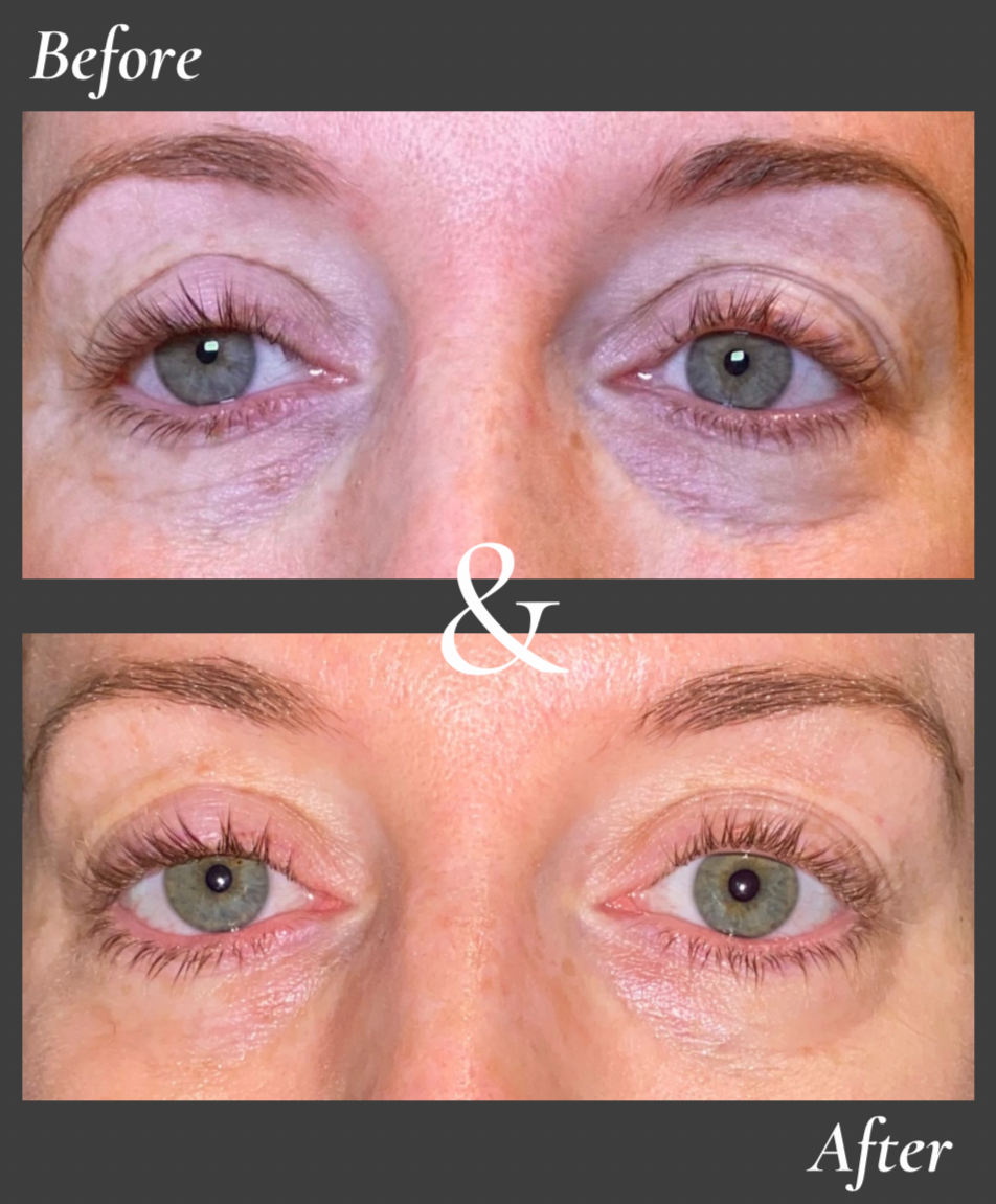 Polynucleotides for dark undereyes before and after Wandsworth clinic
