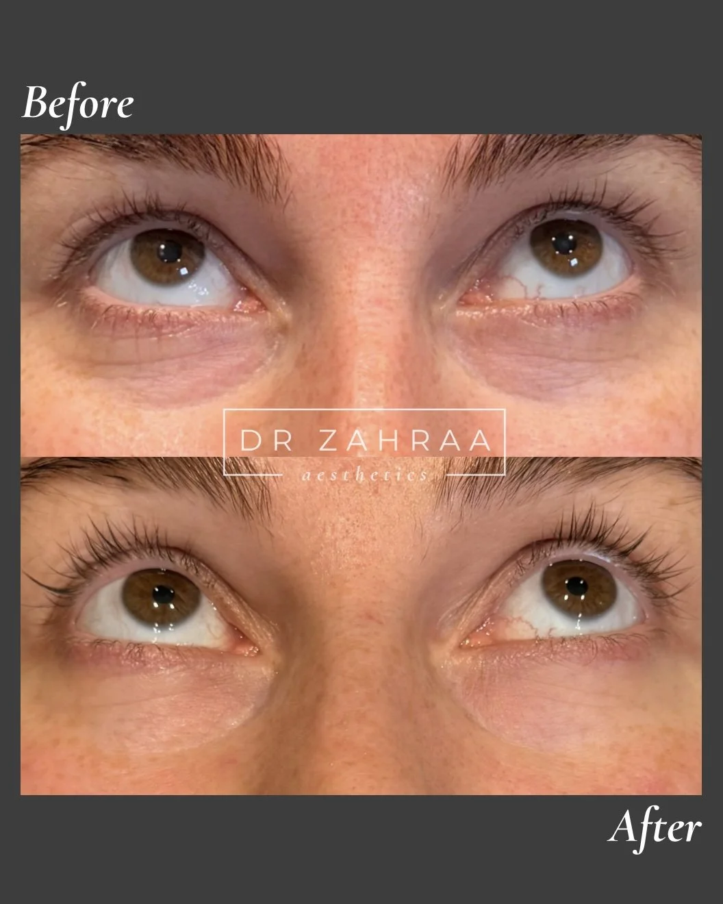 Sunekos Dark Undereye Treatment Wandsworth