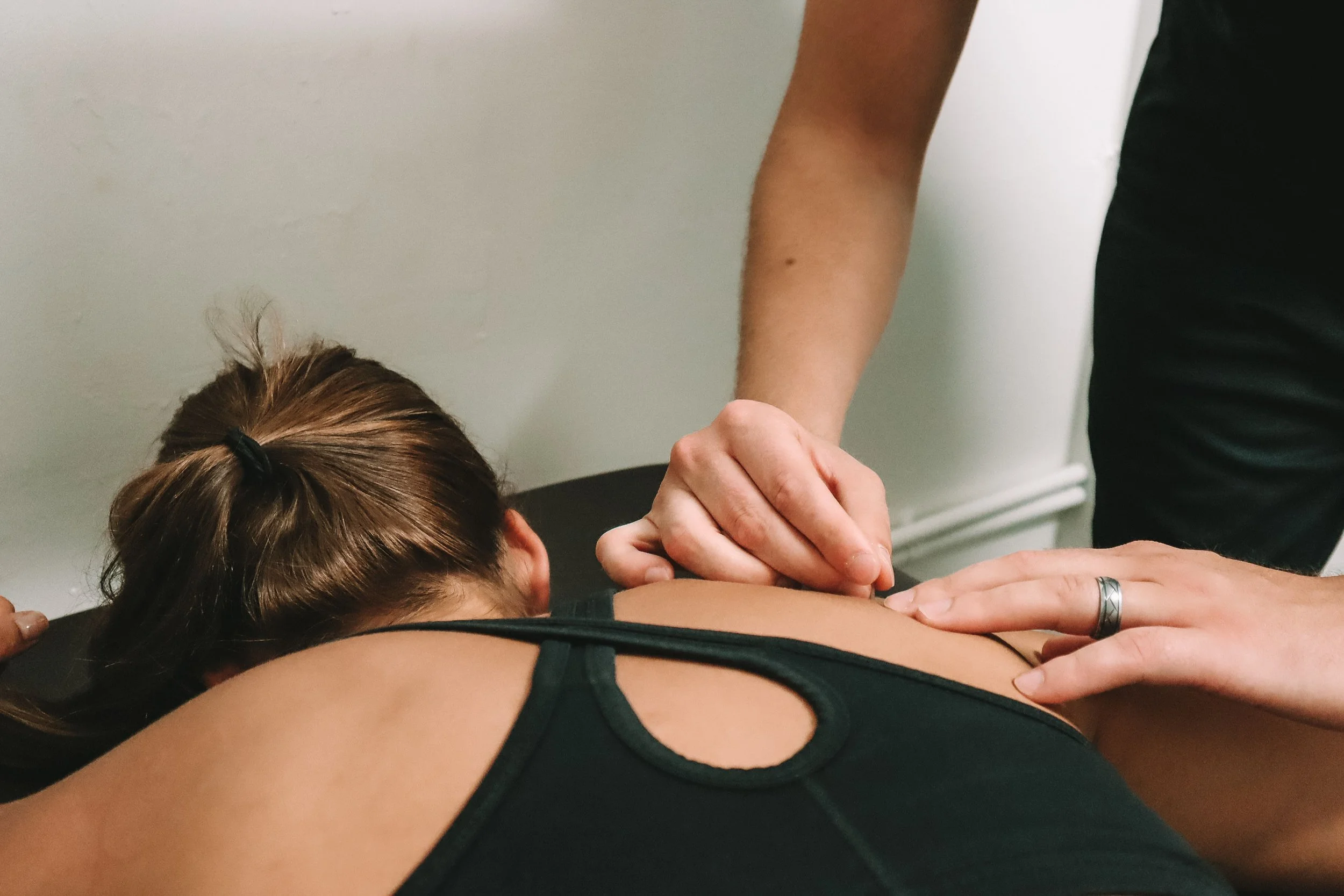Dry needling treatment at physiotherapy clinic in Varsity Lakes