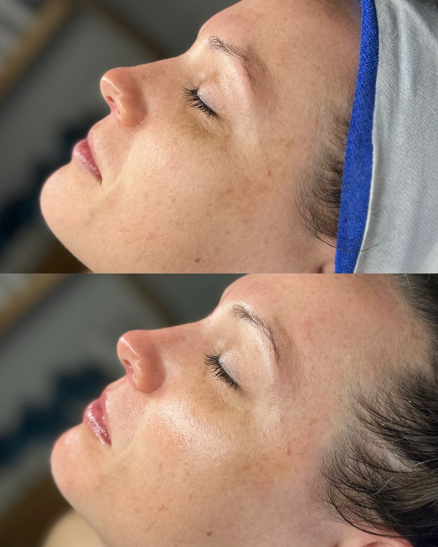 Ask and you shall receive 🤗

This beauty wanted to focus on anti-aging, brightening, &amp; detoxing and we did just that! 

BioRePeel 🤝 Luxe Lift Facial + Dermaplaning of course ✨🌷