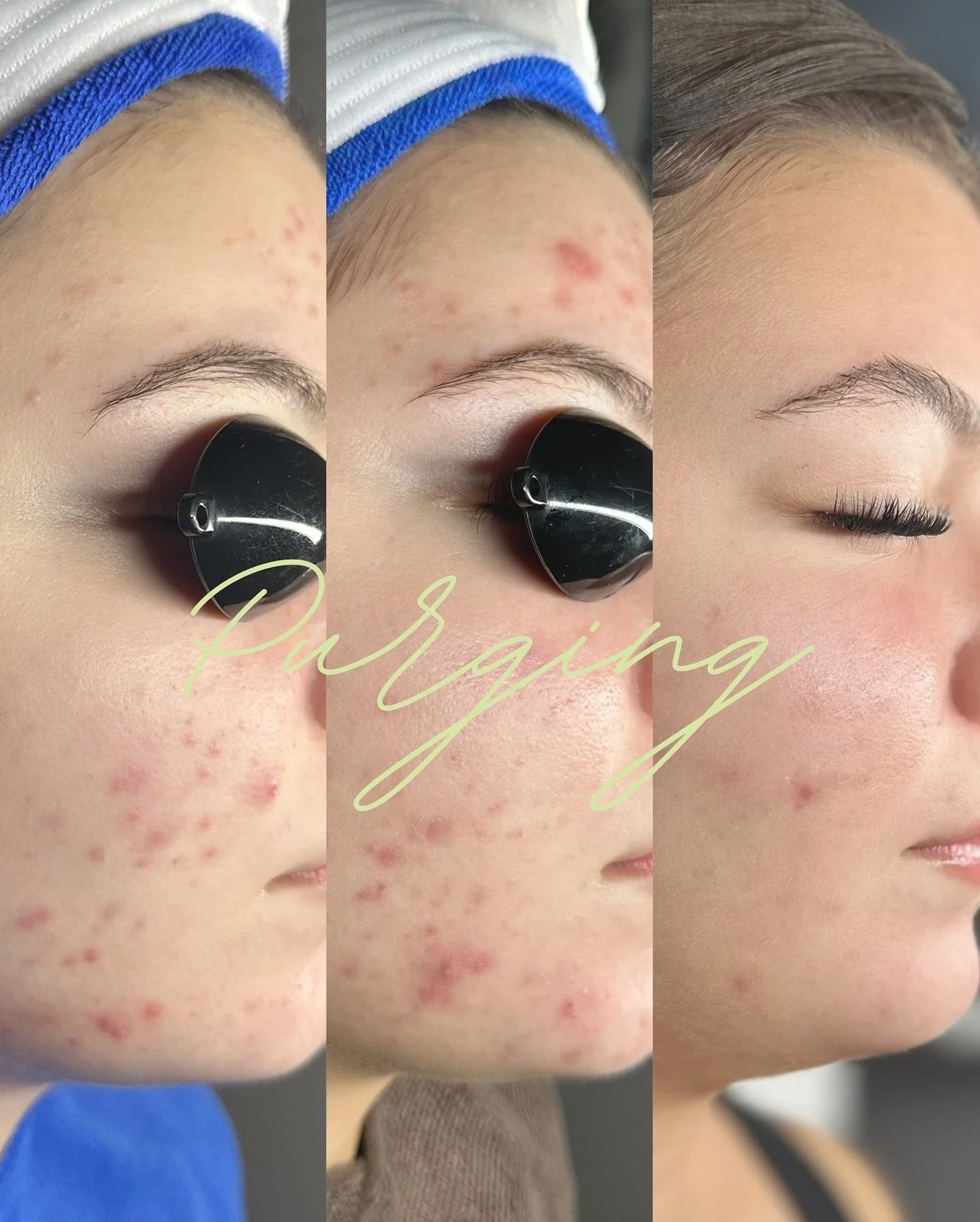 A little storm before the sunshine 🌷

I have a couple of clients experiencing this right now, so I thought what better time to share! When healing acne-prone or congested skin, purging = progress. Keep in mind, what&rsquo;s within has to come out in