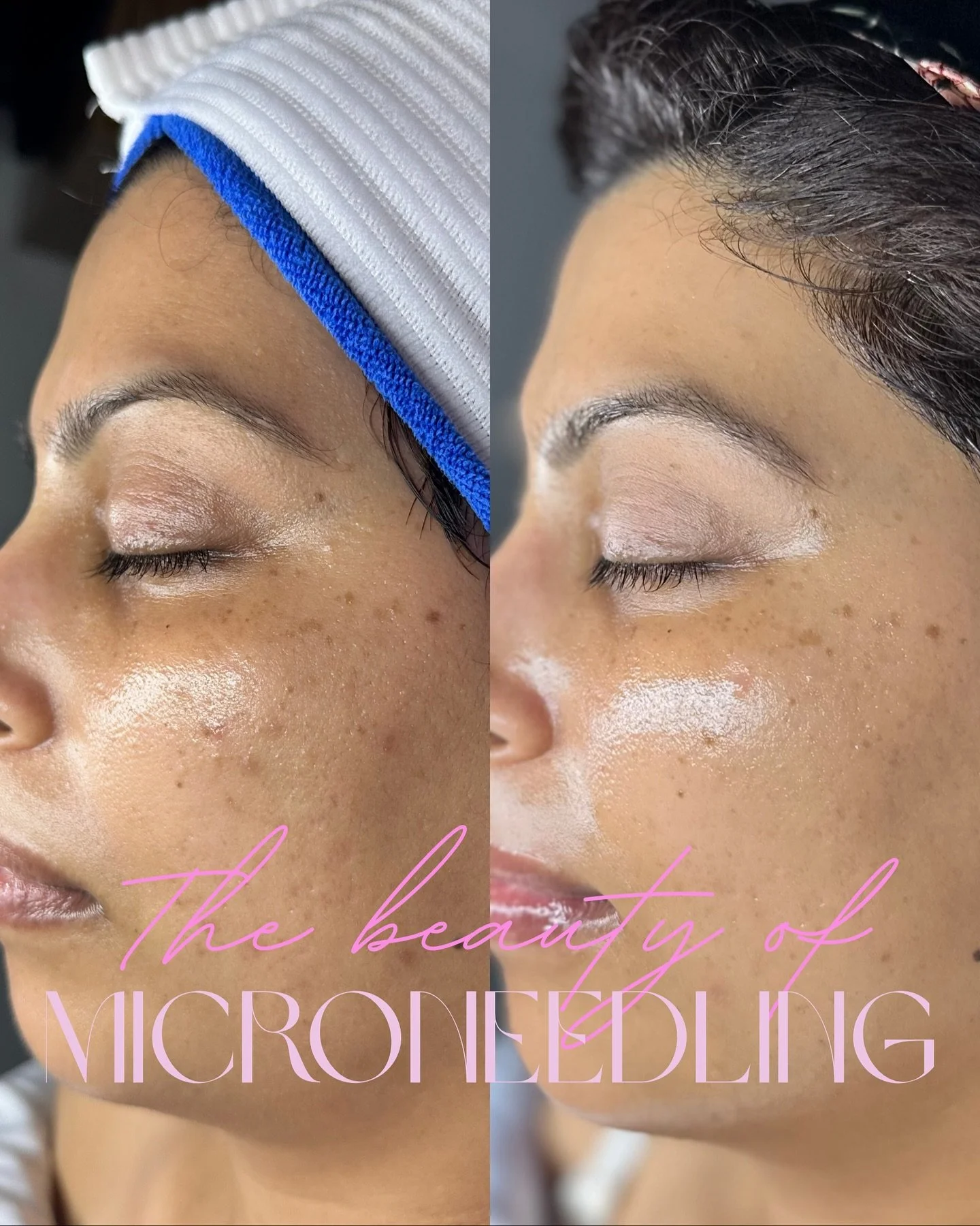 From December to yesterday (Aug 20th 😉) her skin is thriving from our two microneedling sessions + monthly facials in between! 

Microneedling is such an amazing treatment for a variety of skin concerns especially acne scarring, stubborn pigment, an