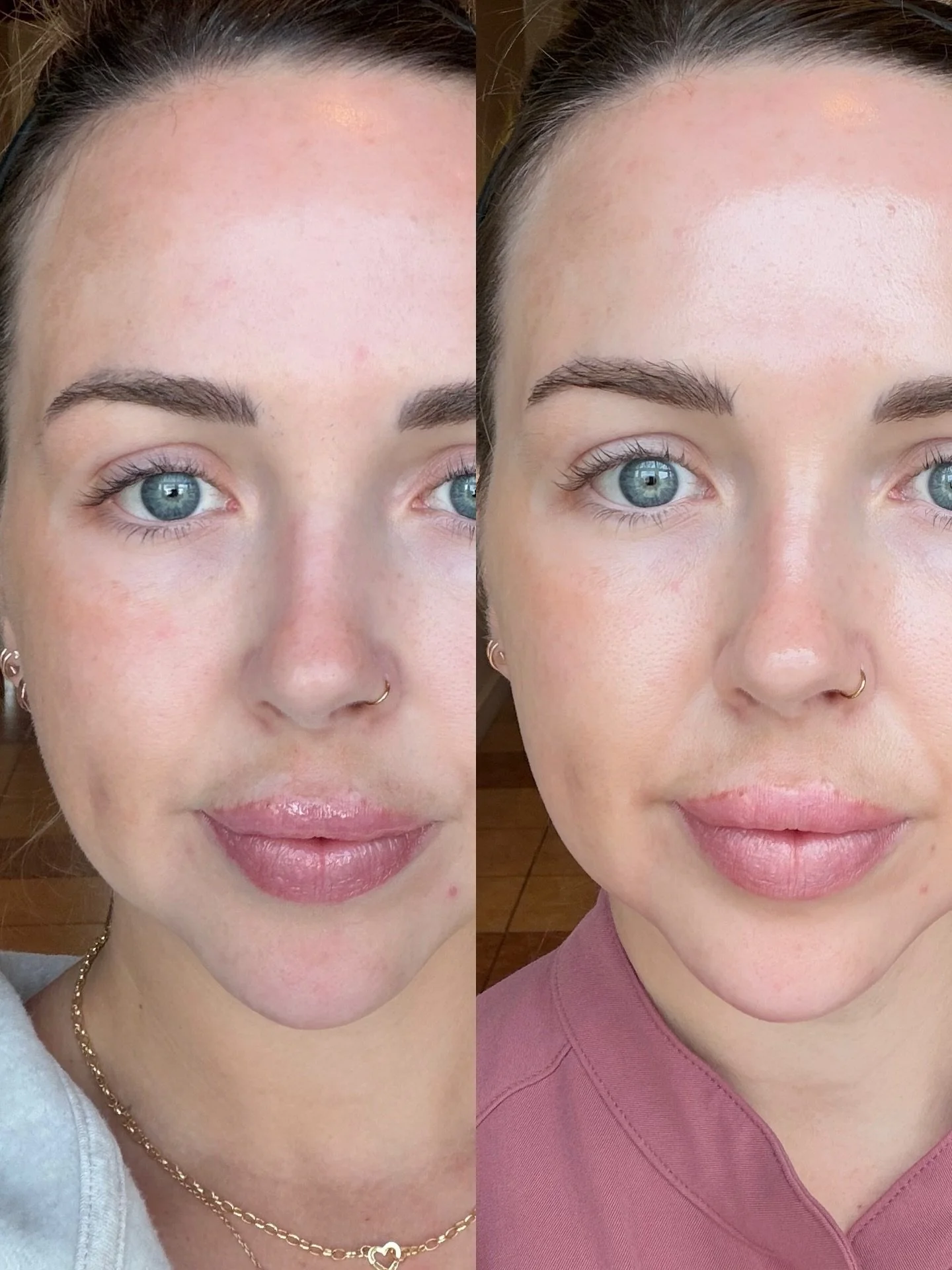 Okay you guys, here&rsquo;s my Perfect Derma&trade; Peel reveal 💙
(9 days in between these photos) 

How I felt before &rarr; dull, congested, hyper-focused on my melasma and uneven skin tone

How I feel after &rarr; squeaky clean, illuminated, plus