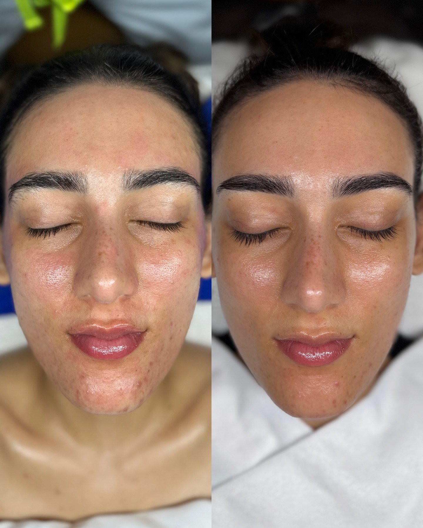 Consistency creates confidence ✨

Over 9 months we restructured her homecare routine, completed 4 facials, and introduced microneedling 🥰

So incredibly happy for her!
