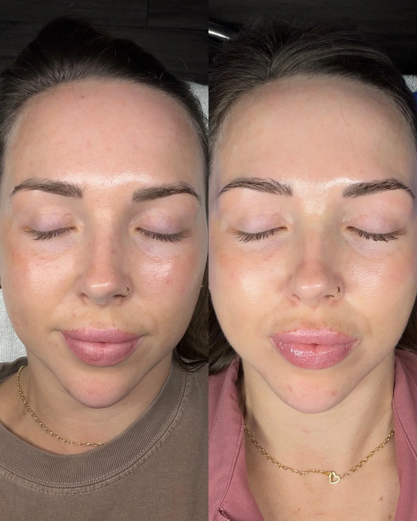 Rebuilt, renewed, and restored ✨

2 treatments and a total of 6 weeks later, my skin is more even, smooth, silky to the touch, + healthier and stronger than ever!

I tried two new treatment serums during these past two sessions, and it&rsquo;s safe t