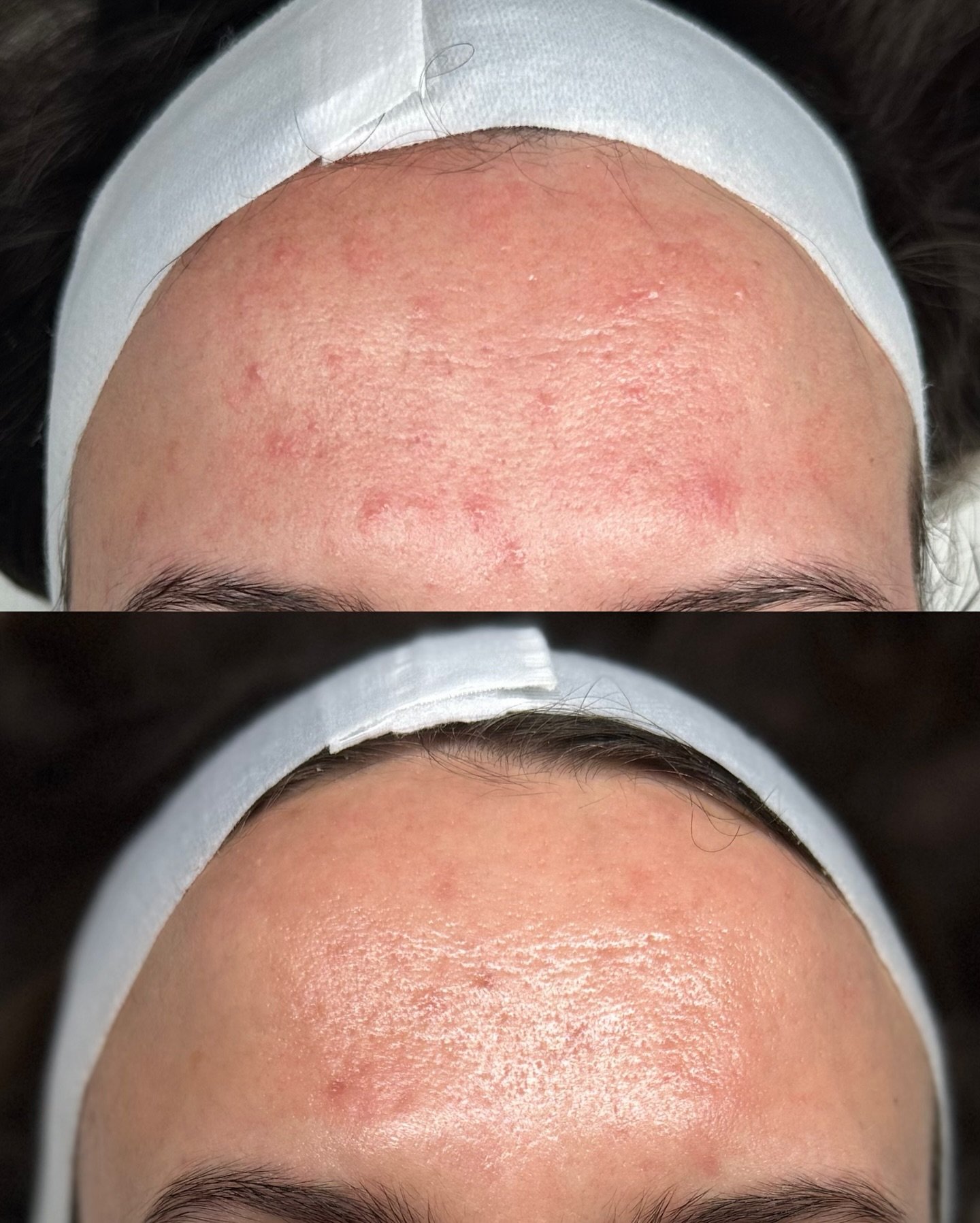 What a feeling 🫶🏼✨

We started her journey 8 months ago, and I&rsquo;d be lying if I said it was always easy BUT she powered through and trusted the process through every wave! 

Watching her skin and confidence bloom is such a special reminder of 