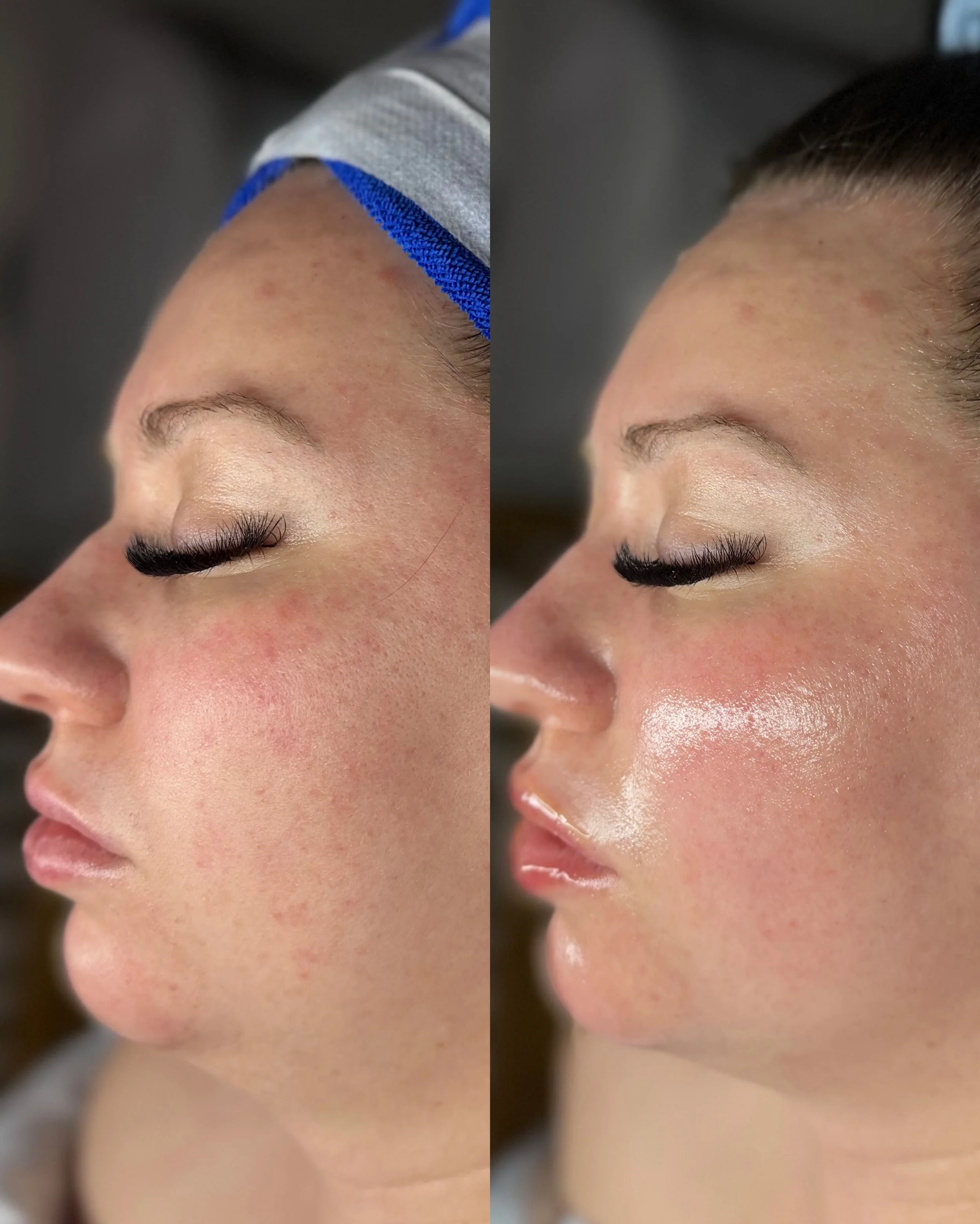 The difference one facial can make 😍

If you&rsquo;ve been thinking about booking, this is your sign 💖