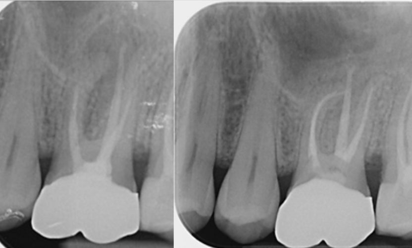 Endodontic Retreatment