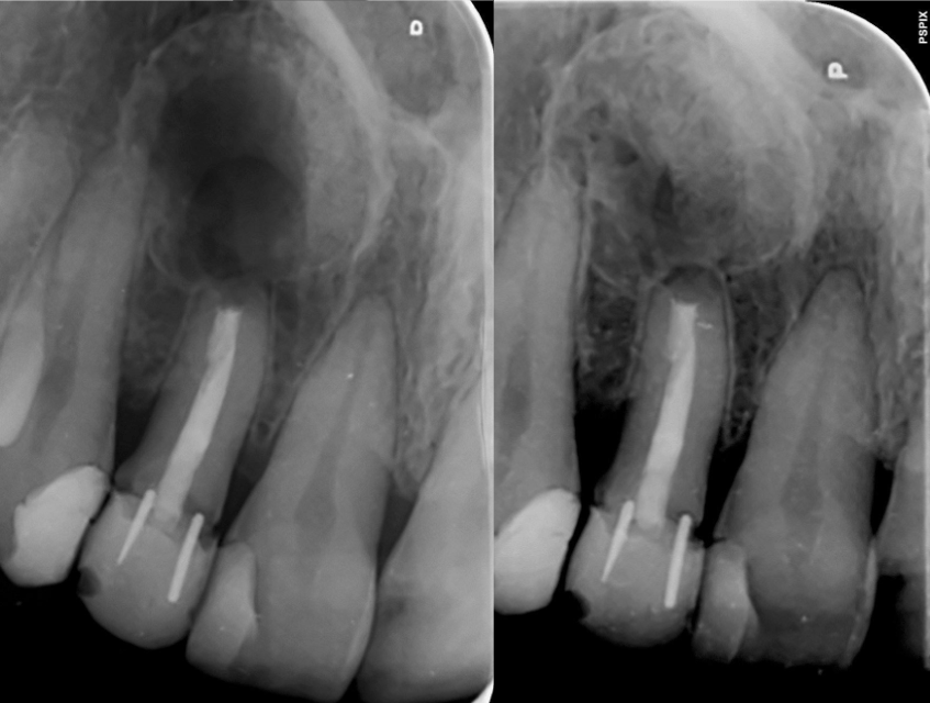 apical microsurgery xray