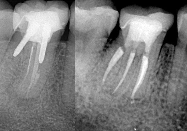 Complex Endodontic Retreatment