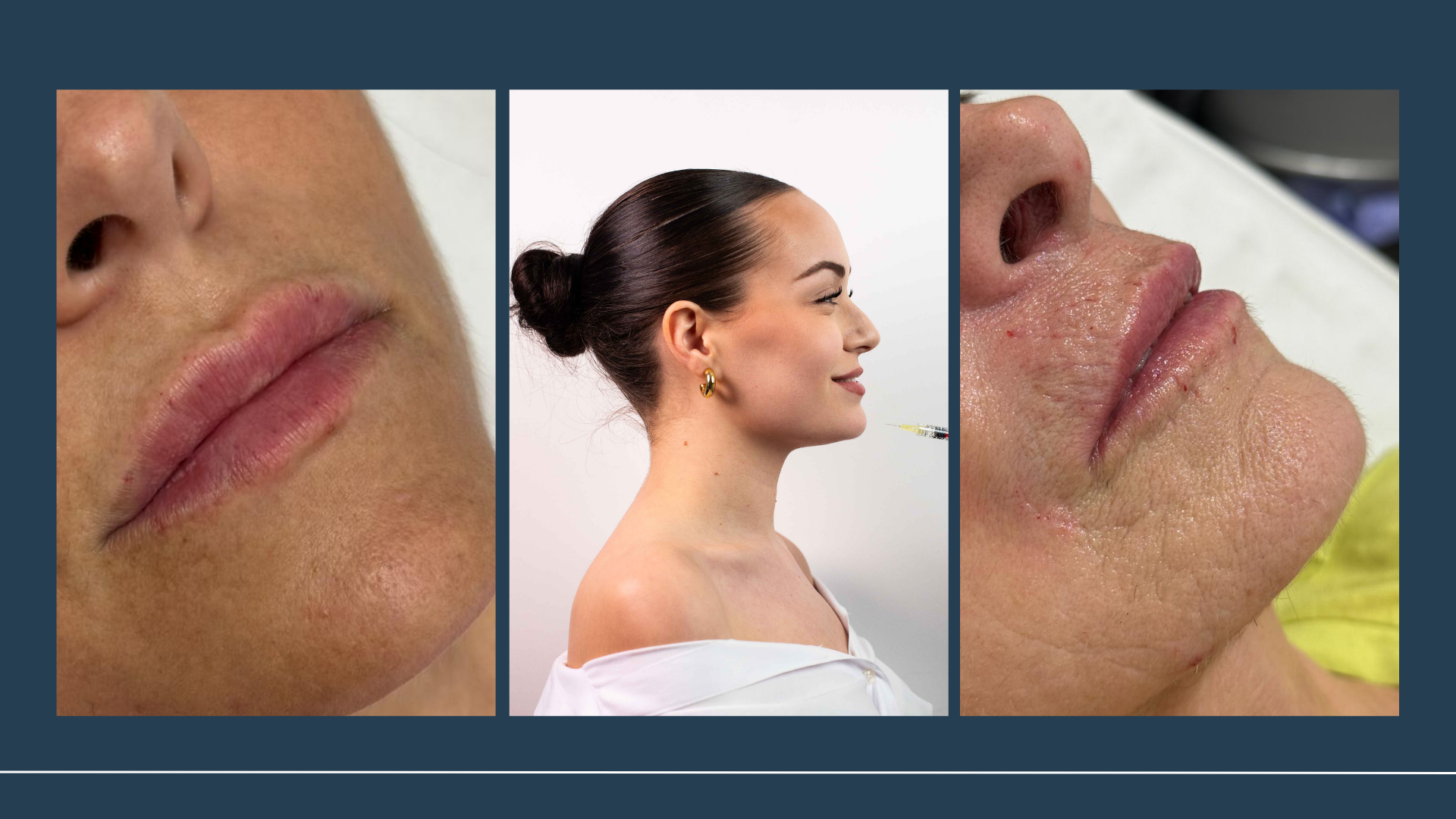 Hidratación de labios en Sevilla: el tratamiento con ácido hialurónico que realza tu belleza natural