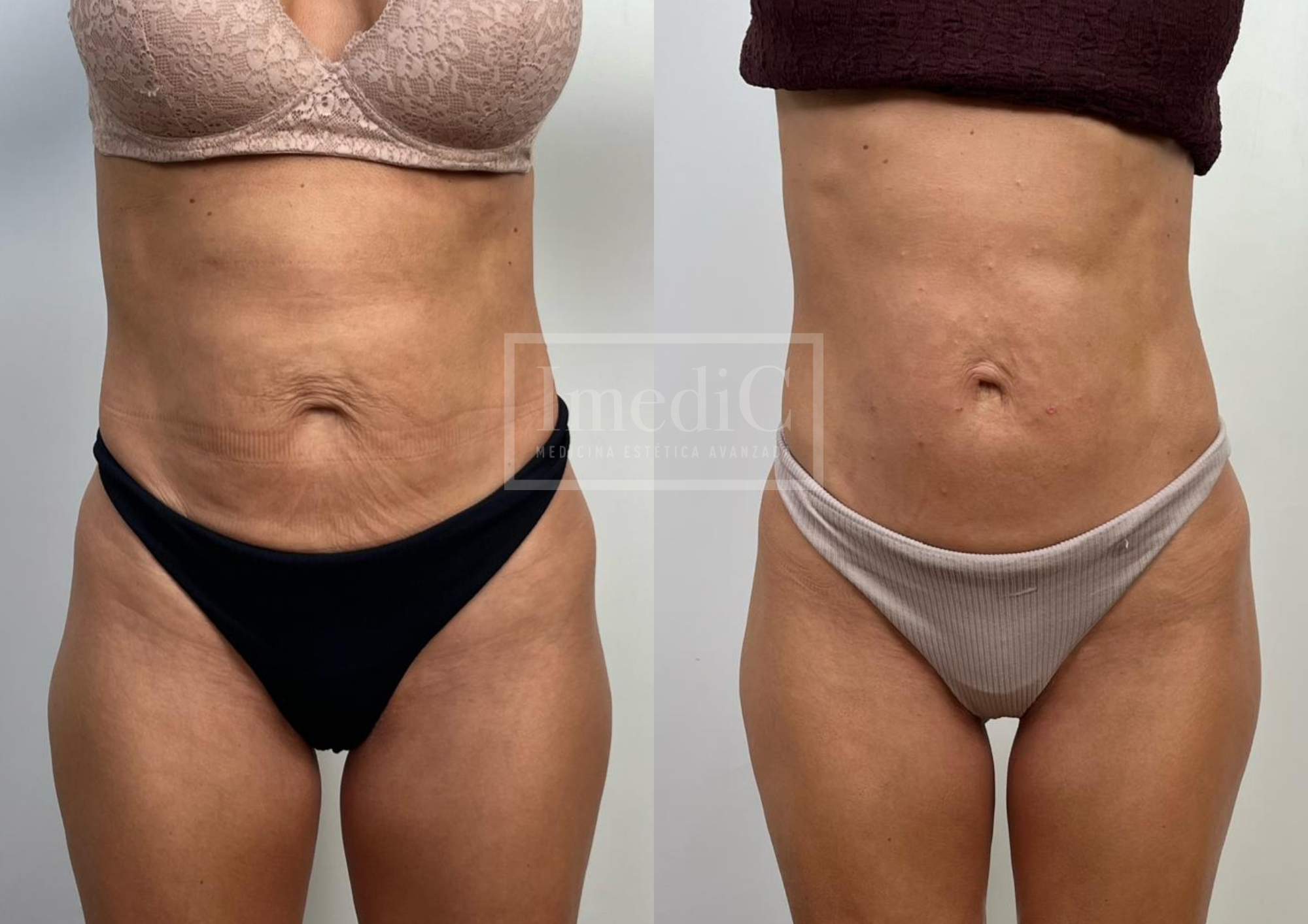 Endolift en abdomen en Sevilla: cómo mejorar la flacidez y la grasa localizada sin cirugía