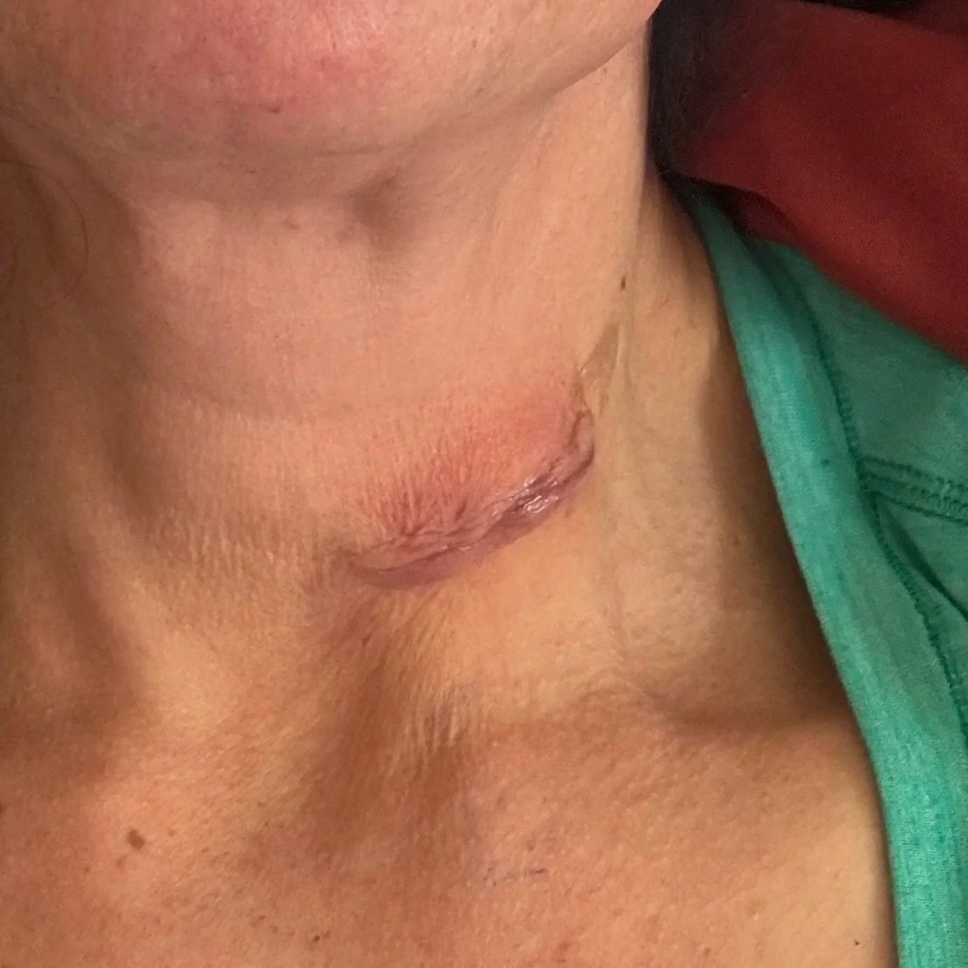 Healing surgical scar on a woman's neck after thyroid surgery.
