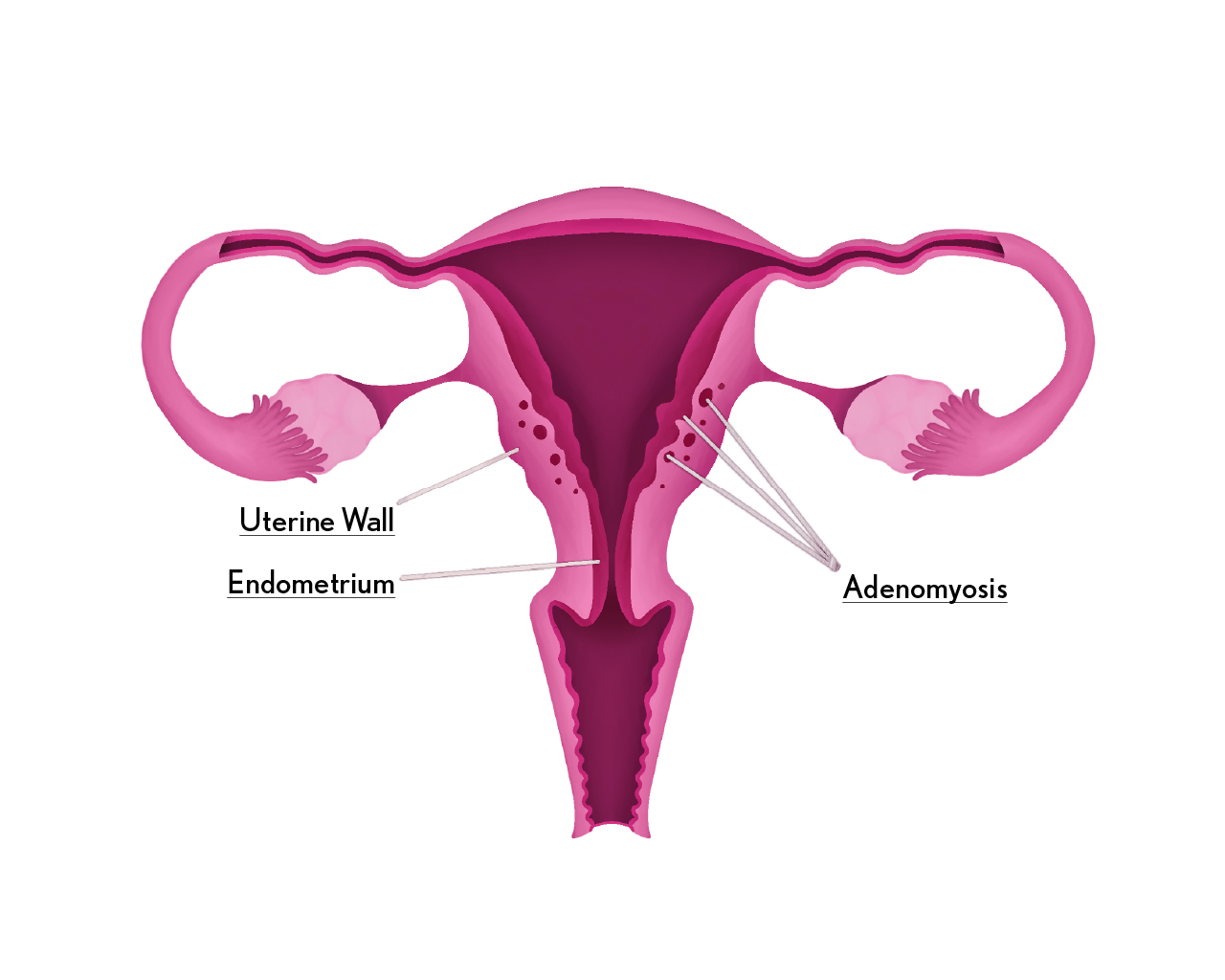 Adenomyosis diagram
