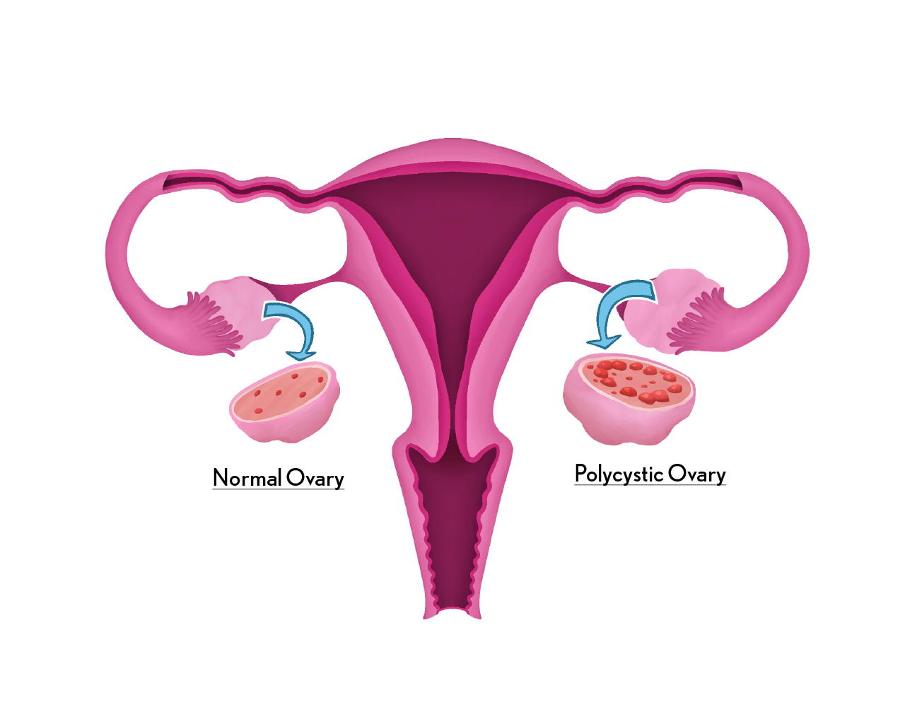 Polycycstic Ovary Syndrome diagram
