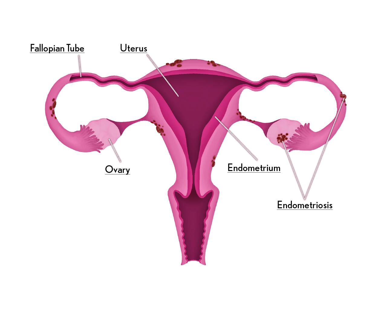 Endometriosis diagram