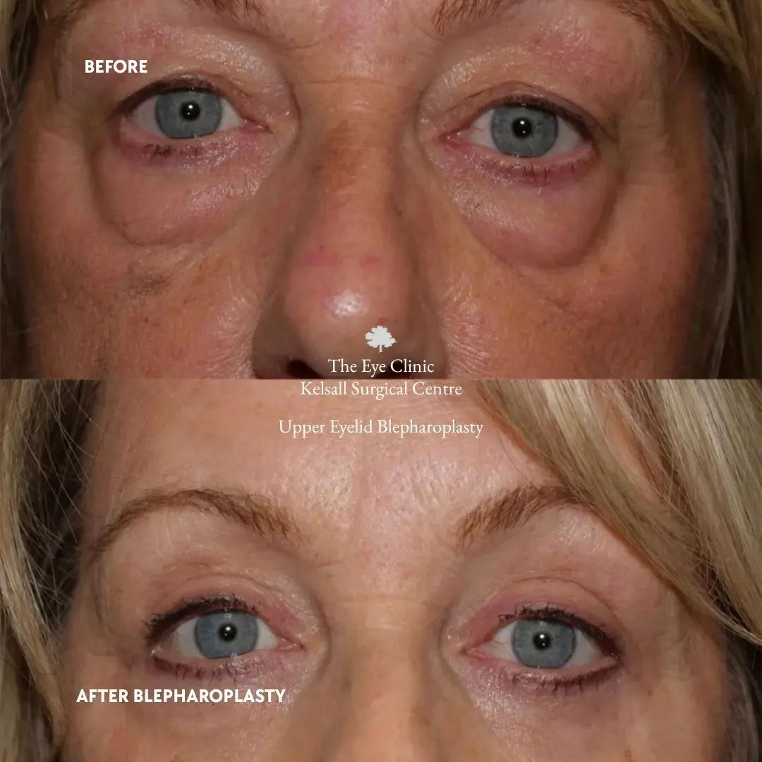 Close-up comparison of a woman's eyes before and after upper eyelid blepharoplasty. The 'before' image shows droopy eyelids with excess skin, while the 'after' image shows more open, youthful eyes with less skin. Text overlay indicates it is from The Eye Clinic, Kelsall Surgical Centre.