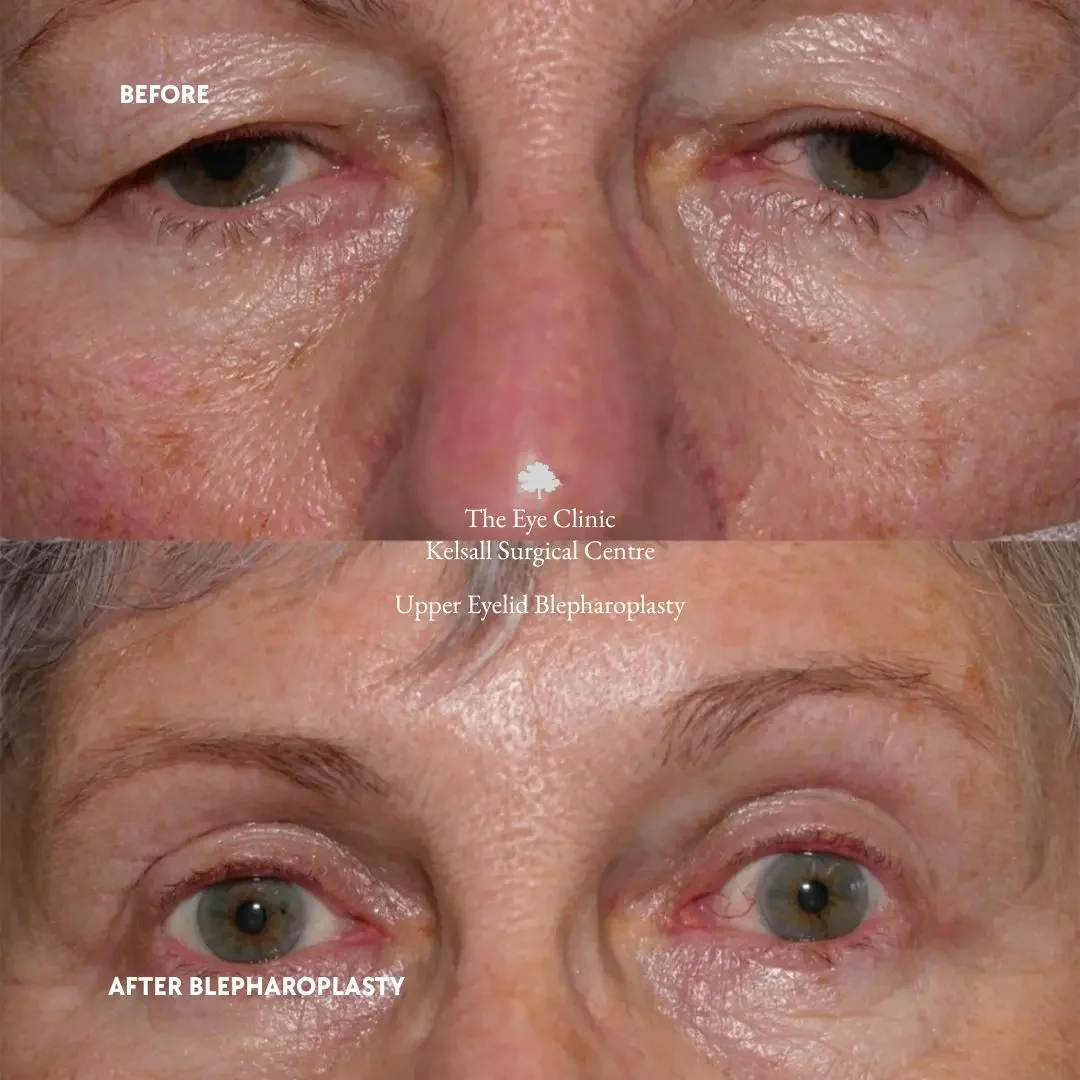 Close-up images showing before and after upper eyelid blepharoplasty. The top image shows droopy eyelids, and the bottom image shows lifted eyelids with less sagging, indicating the surgical results.