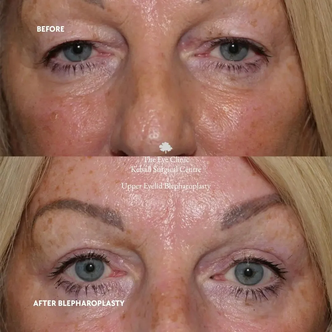 Comparison of a woman's eyes and brows before and after upper eyelid blepharoplasty, showing reduced drooping and improved appearance.