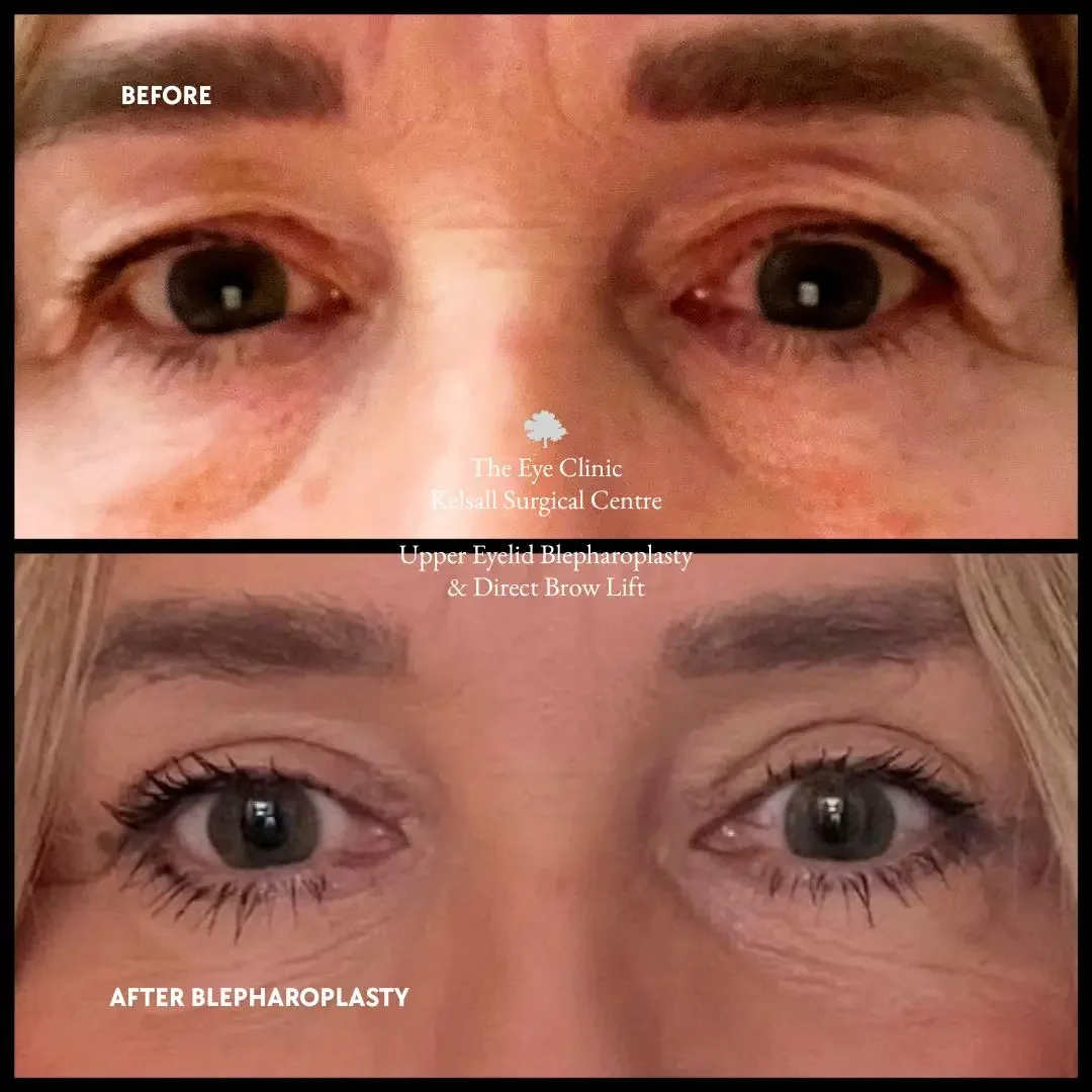 Before and after image of a lady post-eyelid surgery