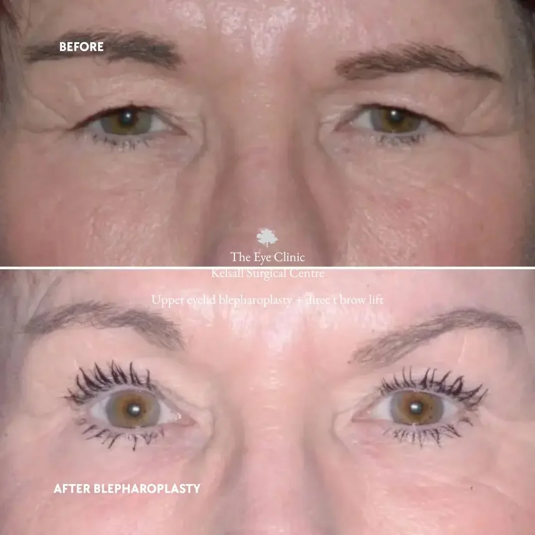 Blepharoplasty surgery before and after photos of a lady