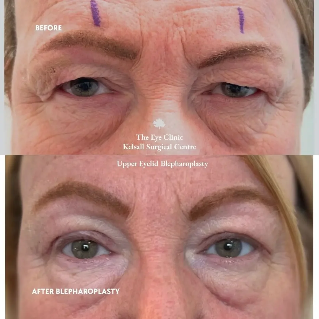 Photo of a lady before and after eyelid surgery