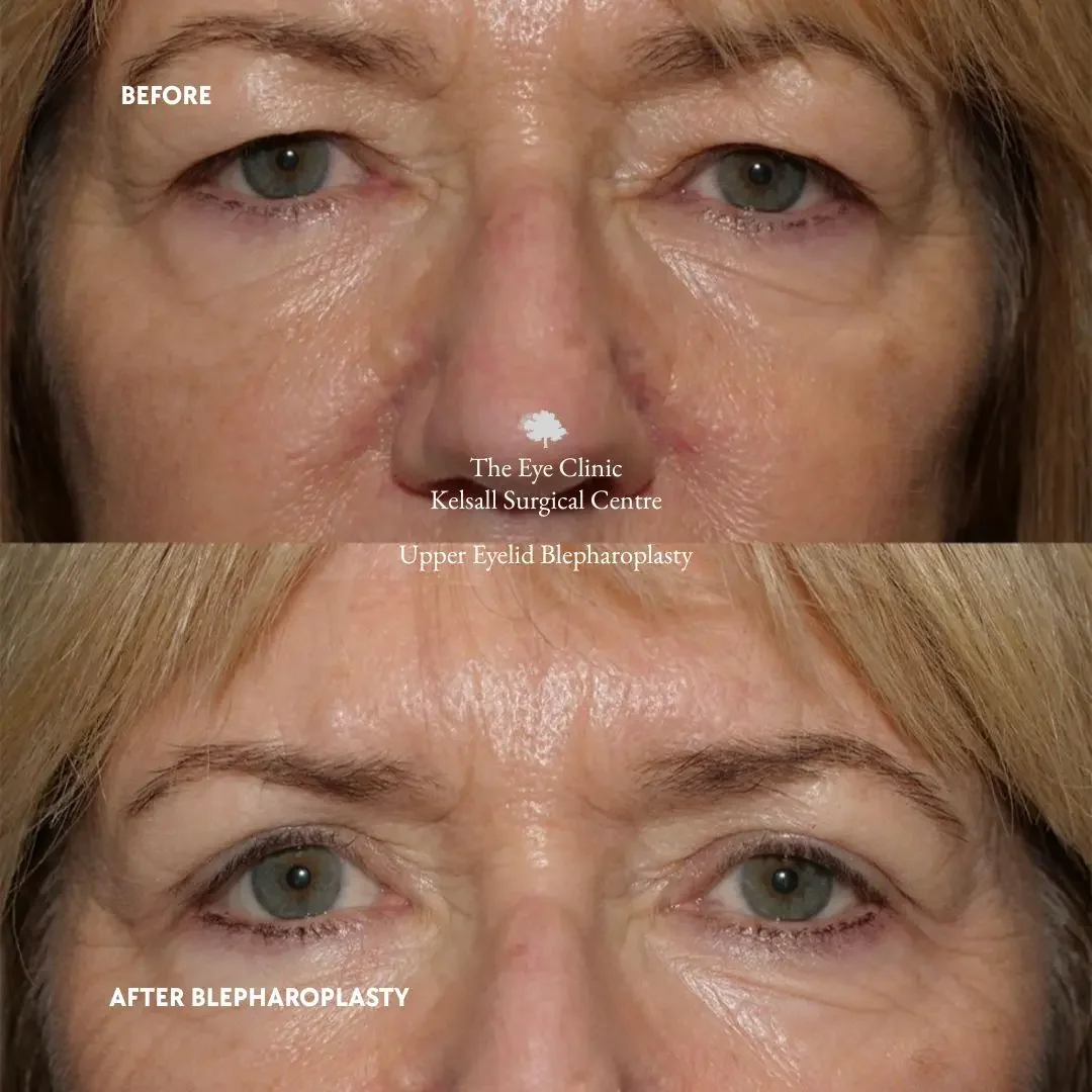 Close-up comparison of a woman's eyes before and after upper eyelid blepharoplasty, showing improved eyelid appearance.